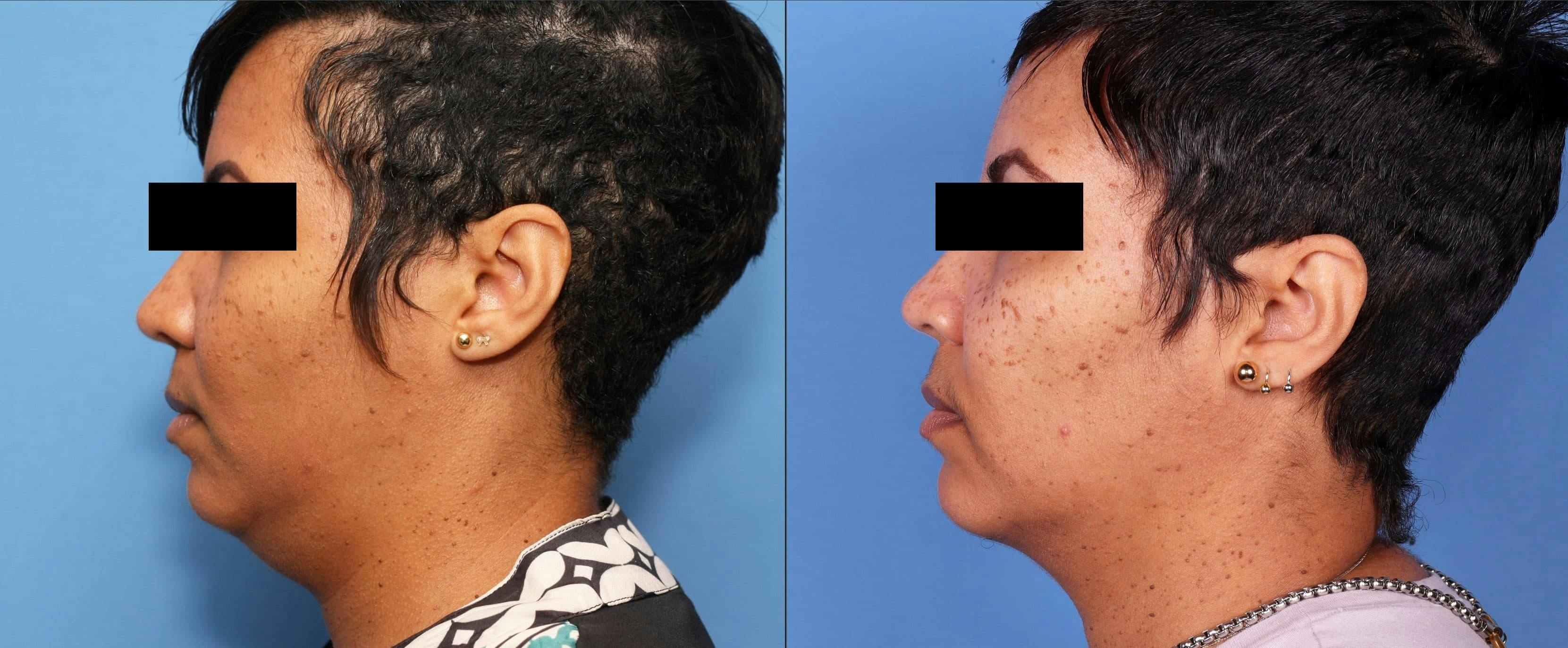 Liposuction Before & After Gallery - Patient 99001664 - Image 3