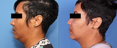 Neck Lift Before & After Gallery - Patient 99001526 - Image 1