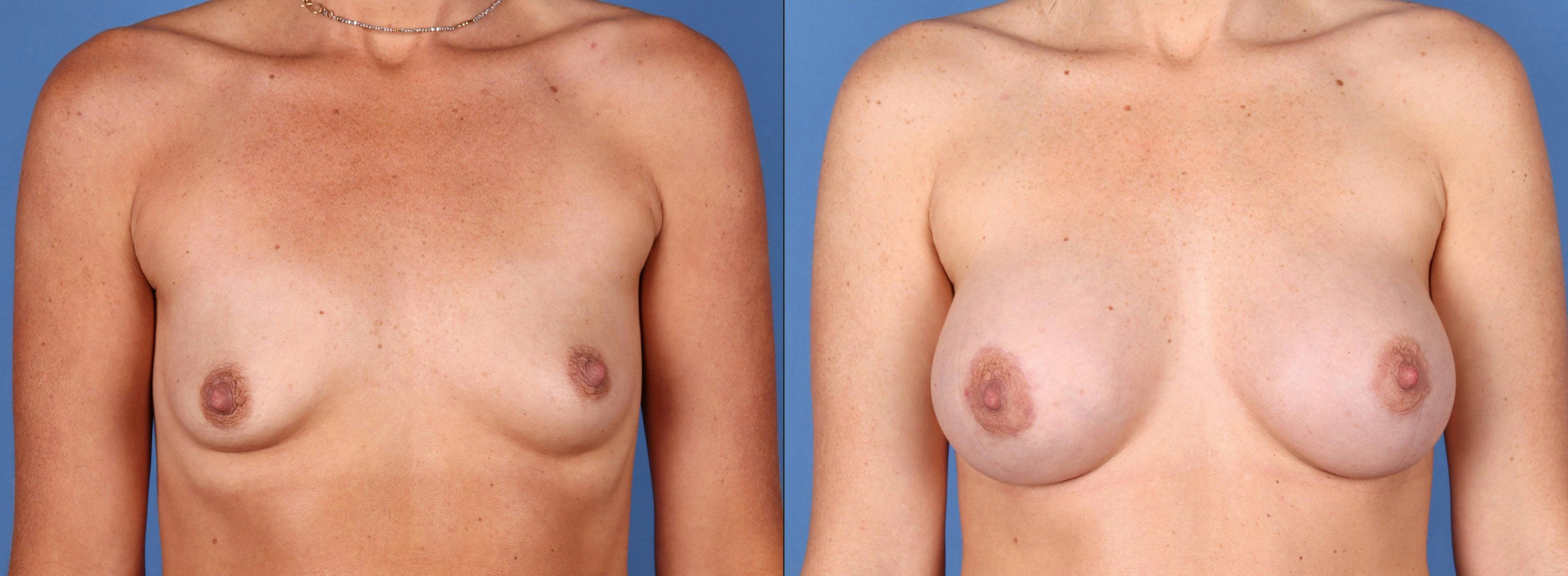 Breast Lift with Augmentation Gallery - Patient 99017145 - Image 1