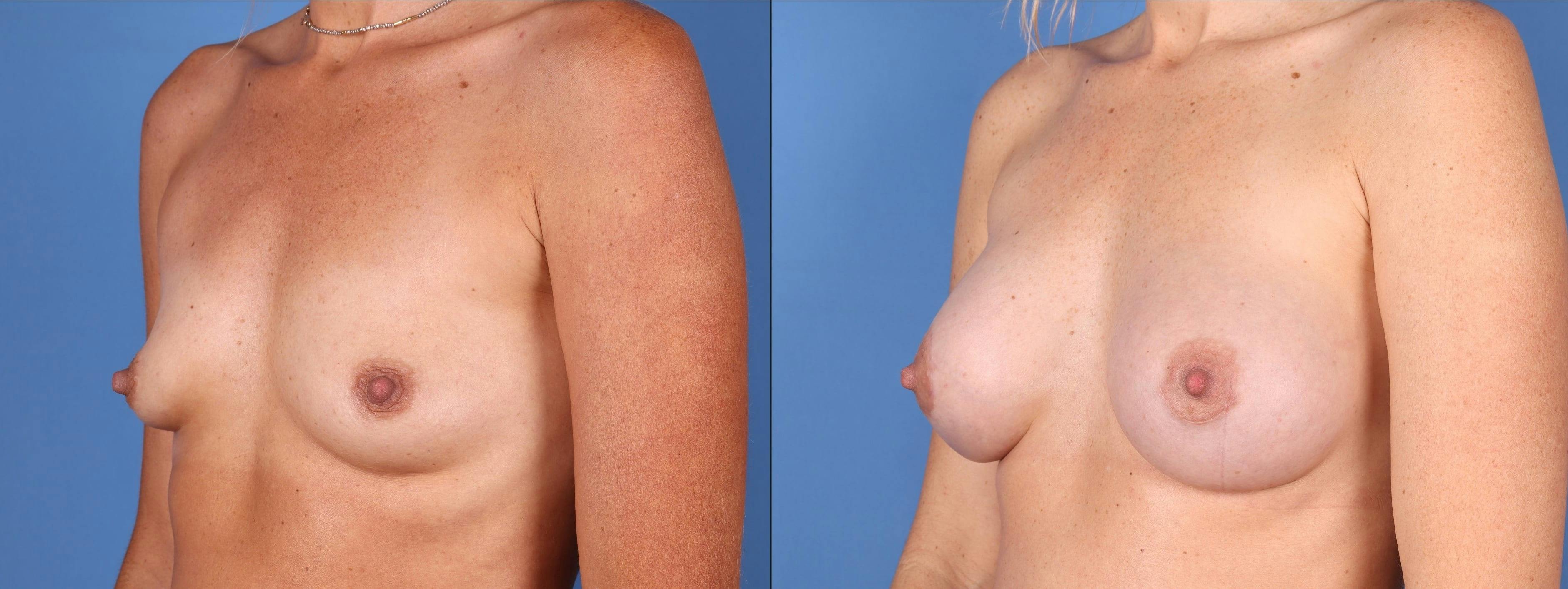 Breast Lift with Augmentation Before & After Gallery - Patient 99017145 - Image 2