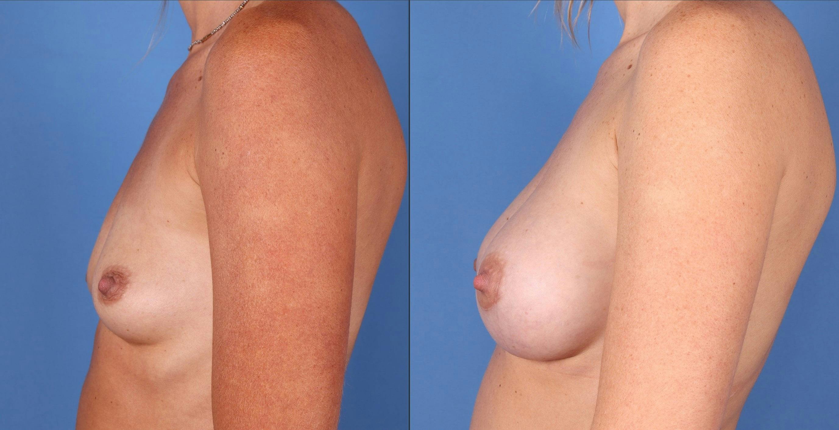 Breast Augmentation Before & After Gallery - Patient 99017140 - Image 3