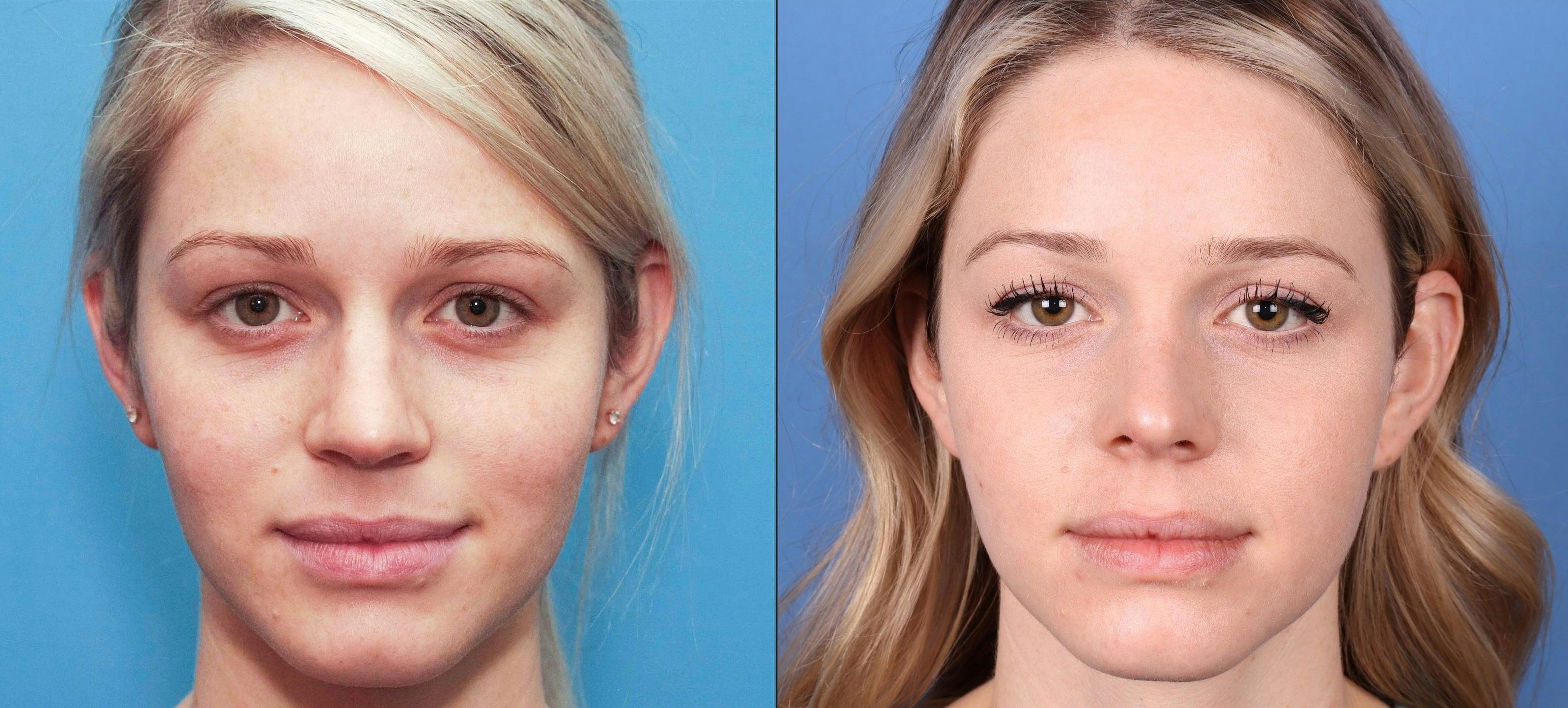 Rhinoplasty Before & After Gallery - Patient 99346226 - Image 2