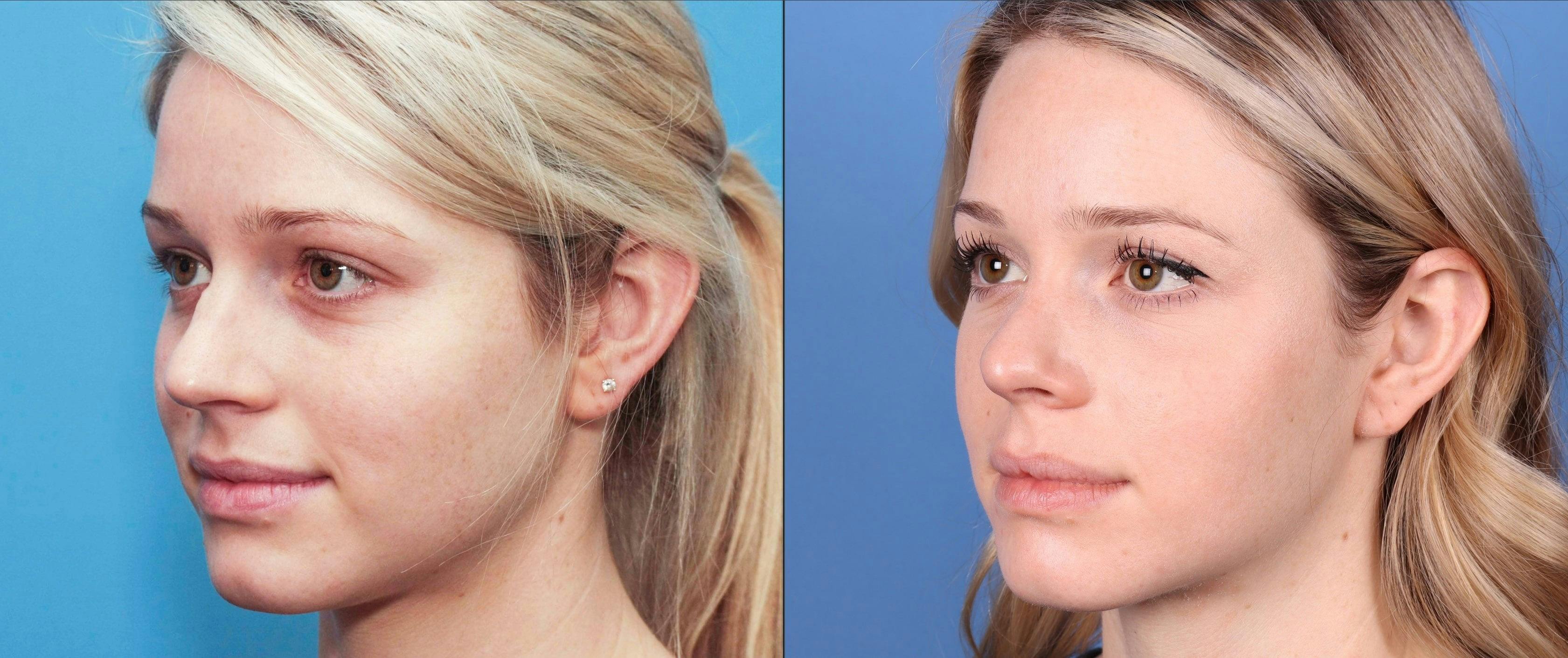 Rhinoplasty Before & After Gallery - Patient 99346226 - Image 3