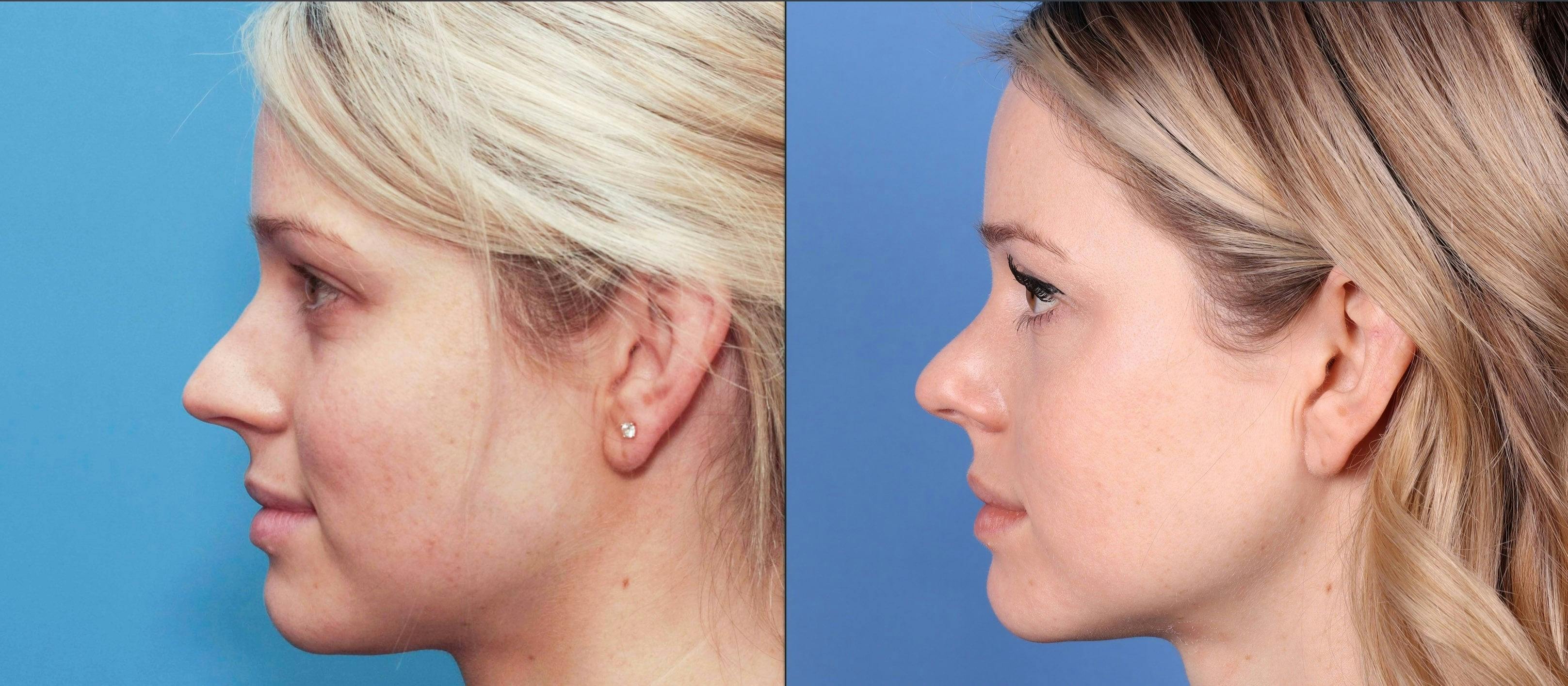 Rhinoplasty Before & After Gallery - Patient 99346226 - Image 1