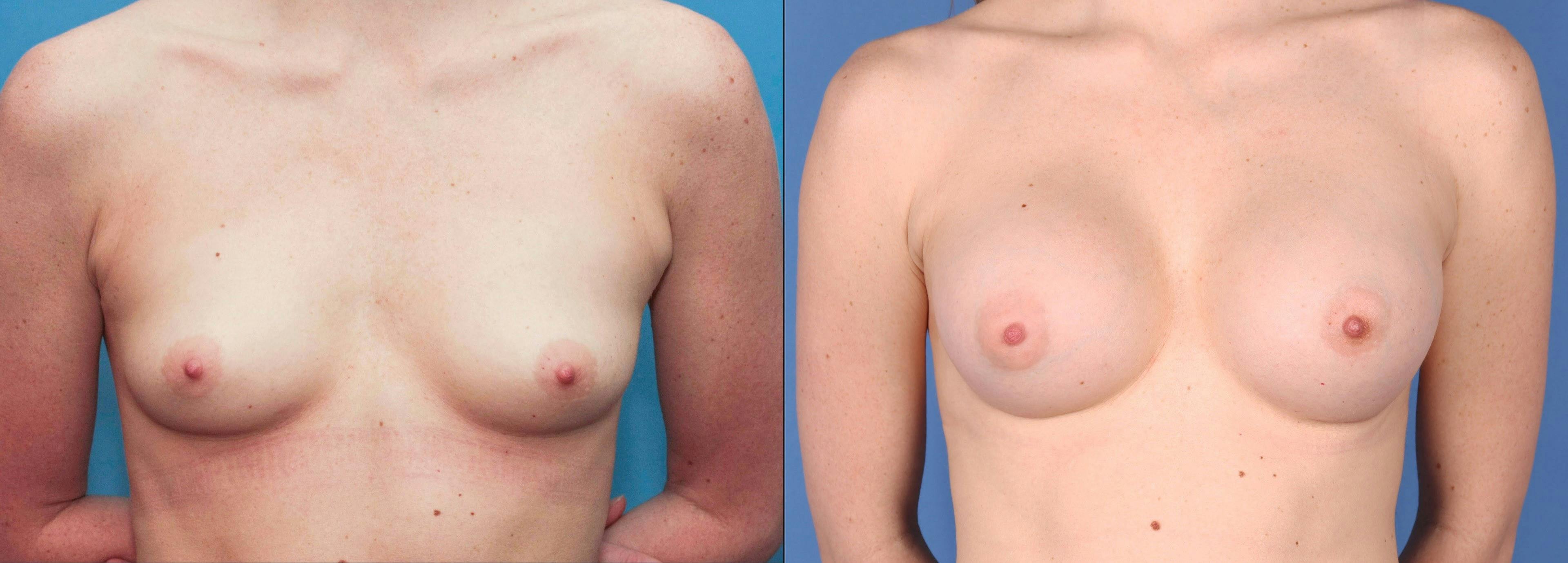 Breast Augmentation Before & After Gallery - Patient 99346241 - Image 1