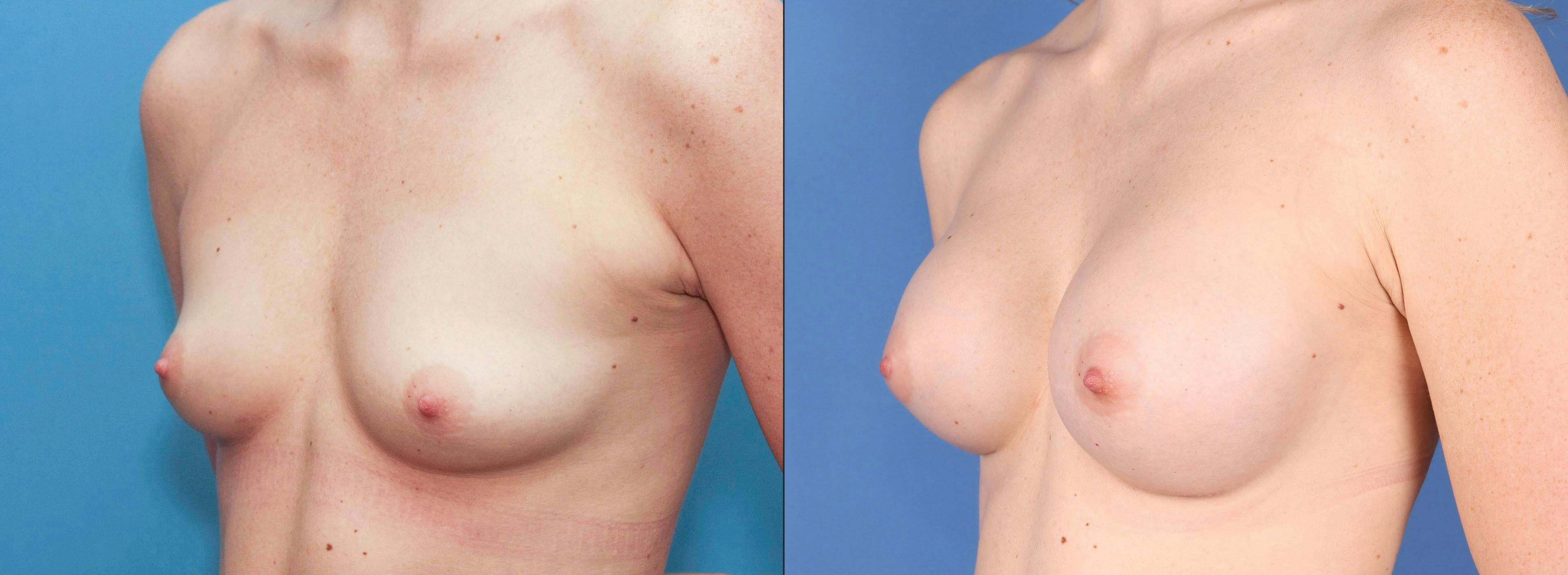 Breast Augmentation Before & After Gallery - Patient 99346241 - Image 2