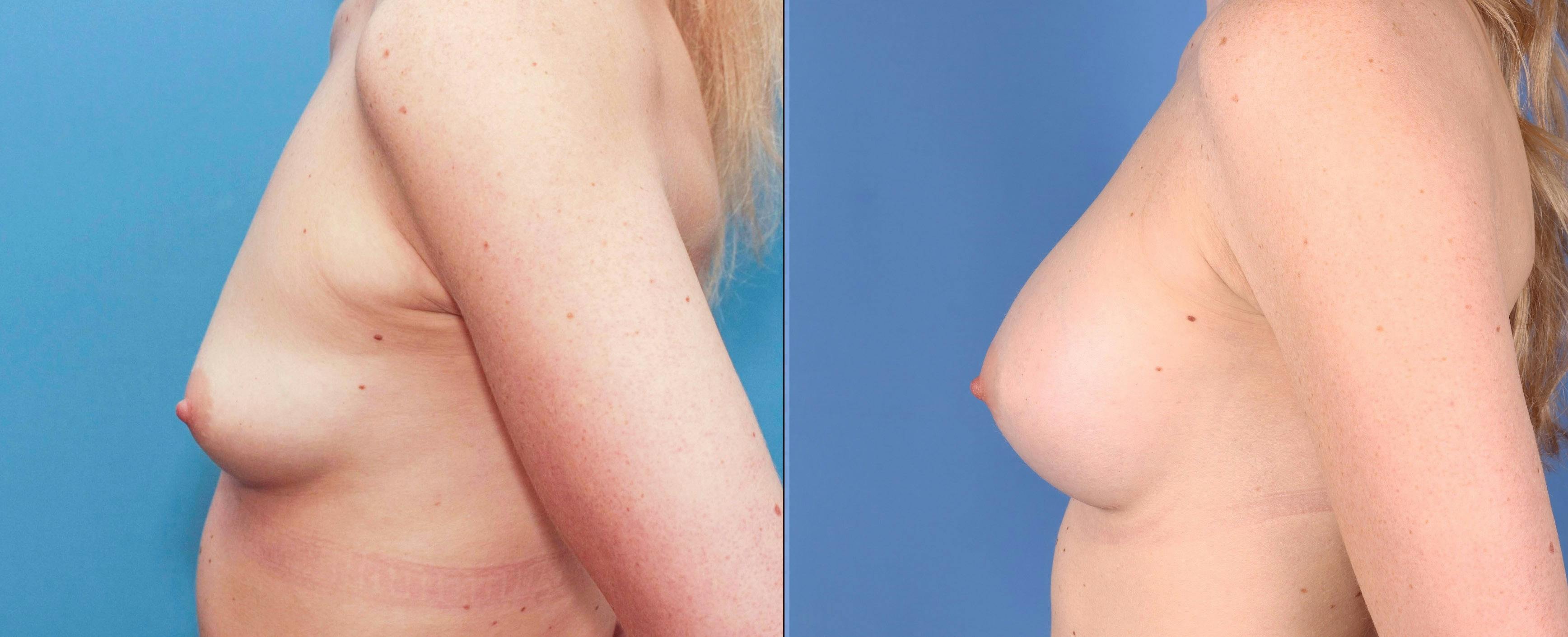 Breast Augmentation Before & After Gallery - Patient 99346241 - Image 3