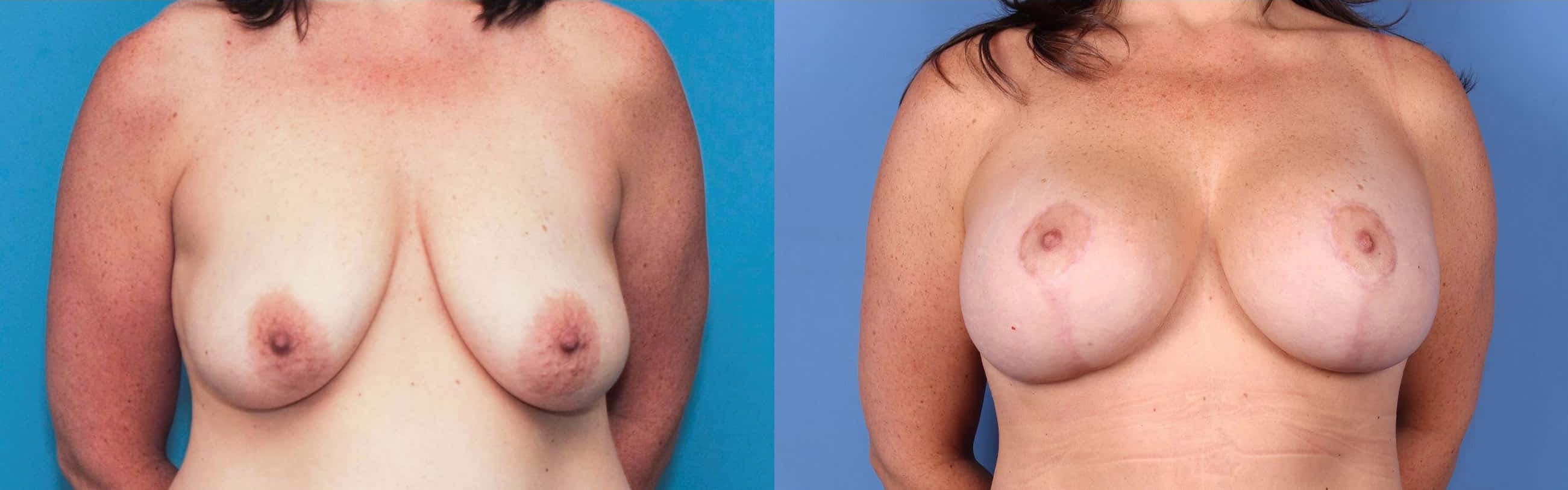 Breast Lift with Augmentation Before & After Gallery - Patient 99346274 - Image 1
