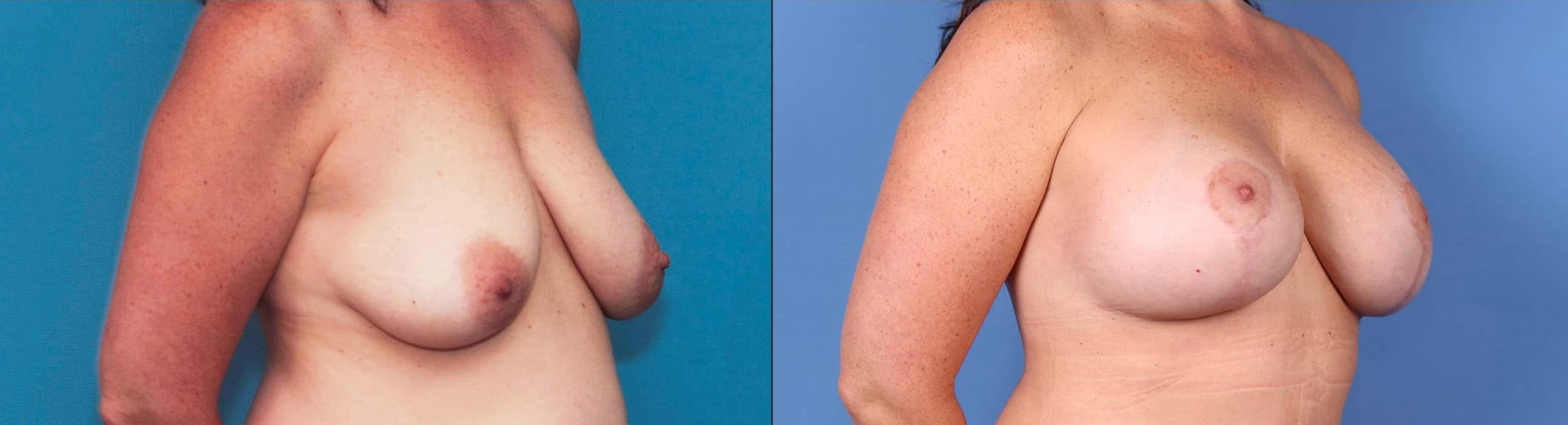 Breast Lift with Augmentation Before & After Gallery - Patient 99346274 - Image 2