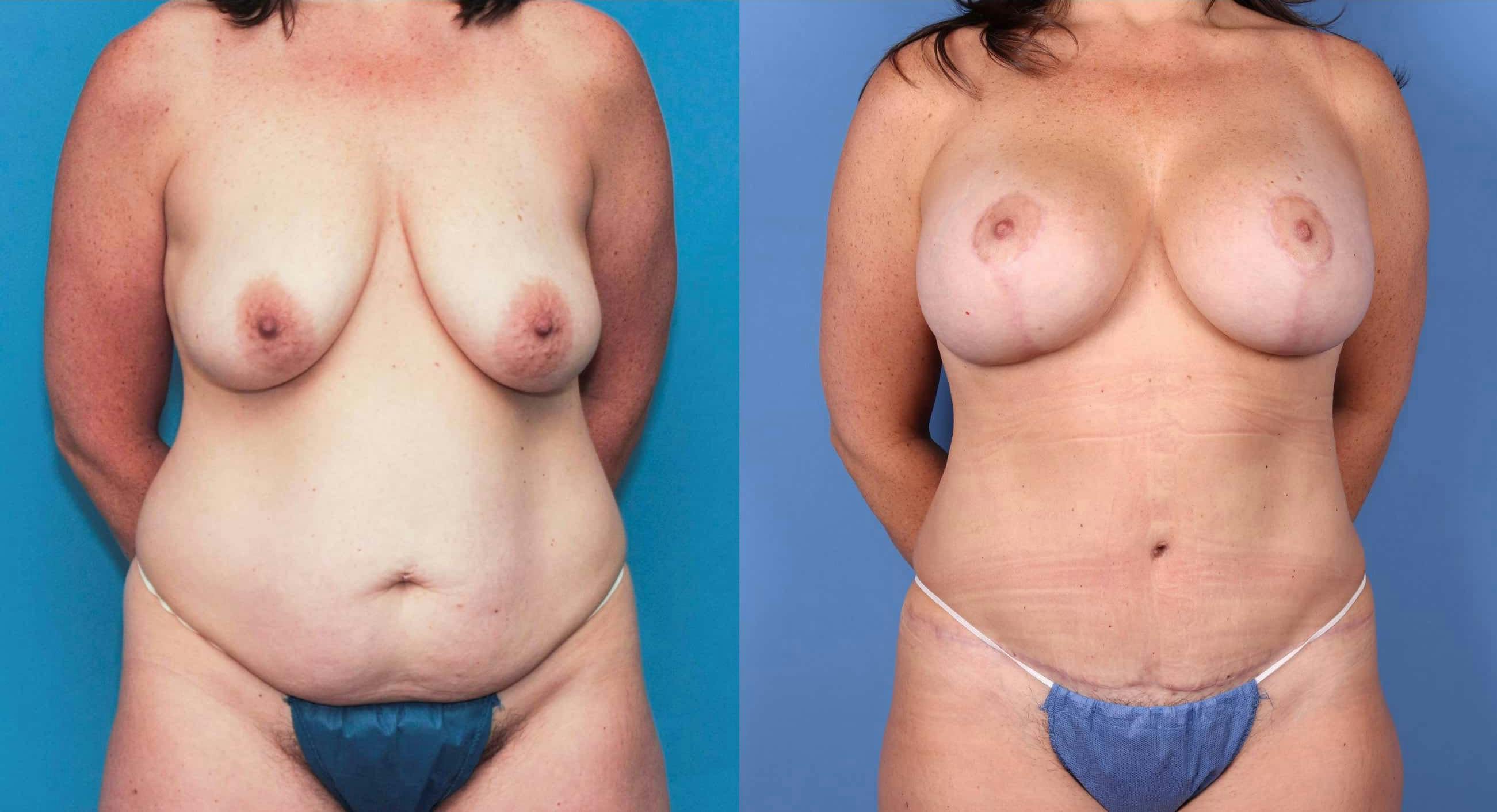 Tummy Tuck Before & After Gallery - Patient 99346285 - Image 1
