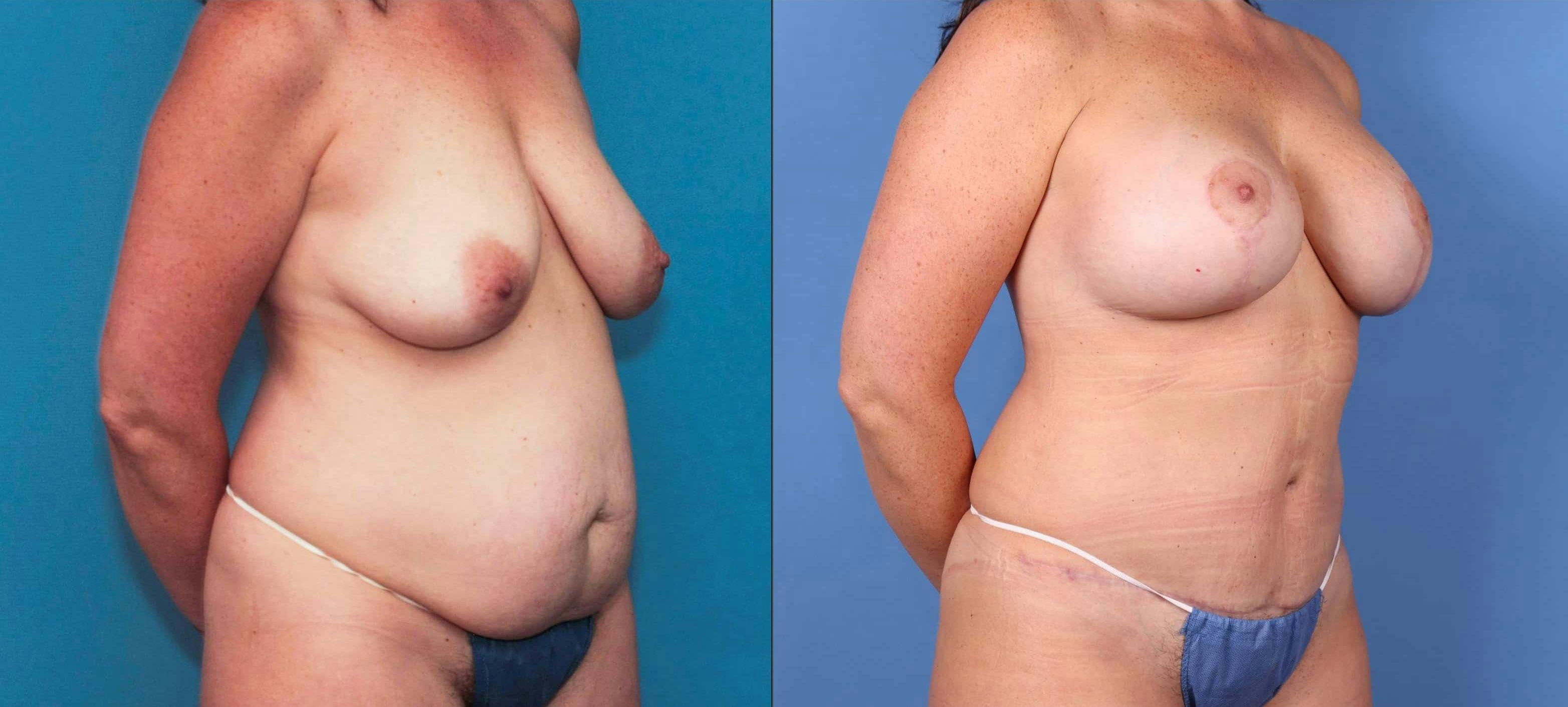 Mommy Makeover Before & After Gallery - Patient 99346283 - Image 2