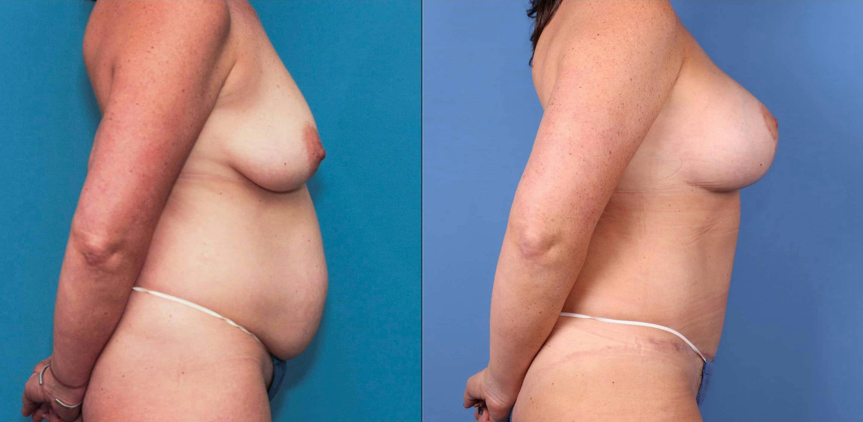 Tummy Tuck Before & After Gallery - Patient 99346285 - Image 3
