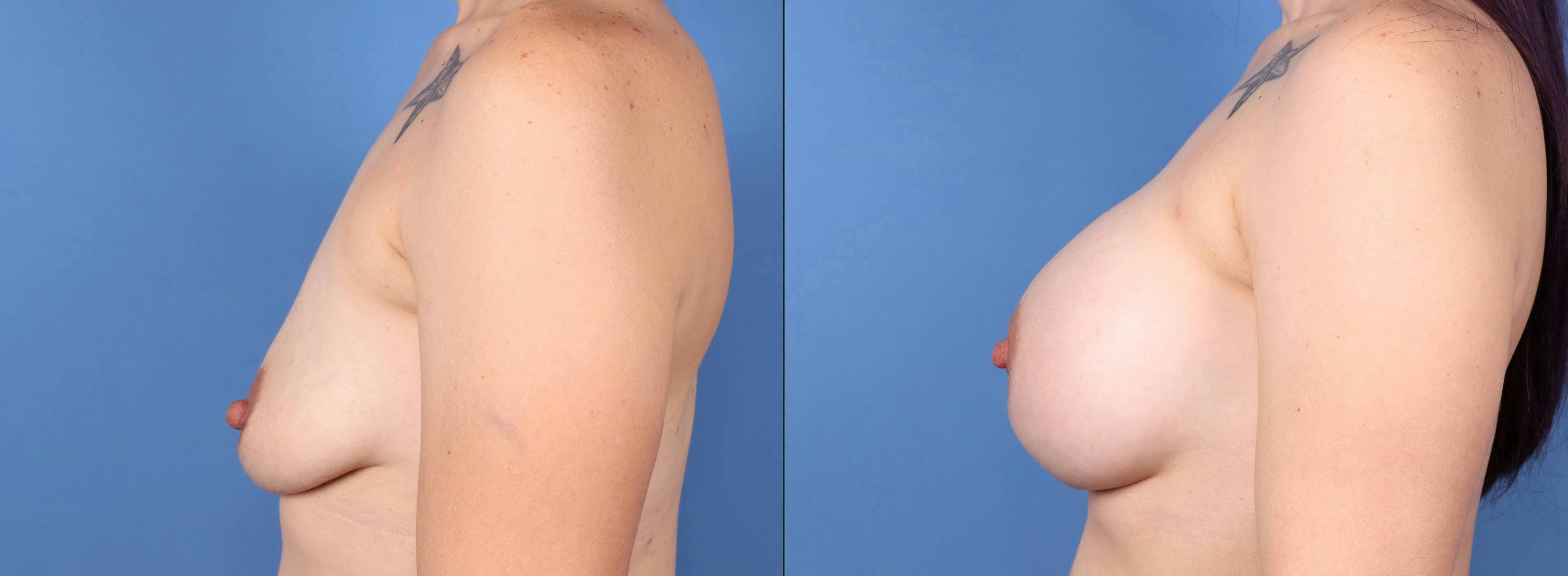 Breast Revision Before & After Gallery - Patient 99346310 - Image 3