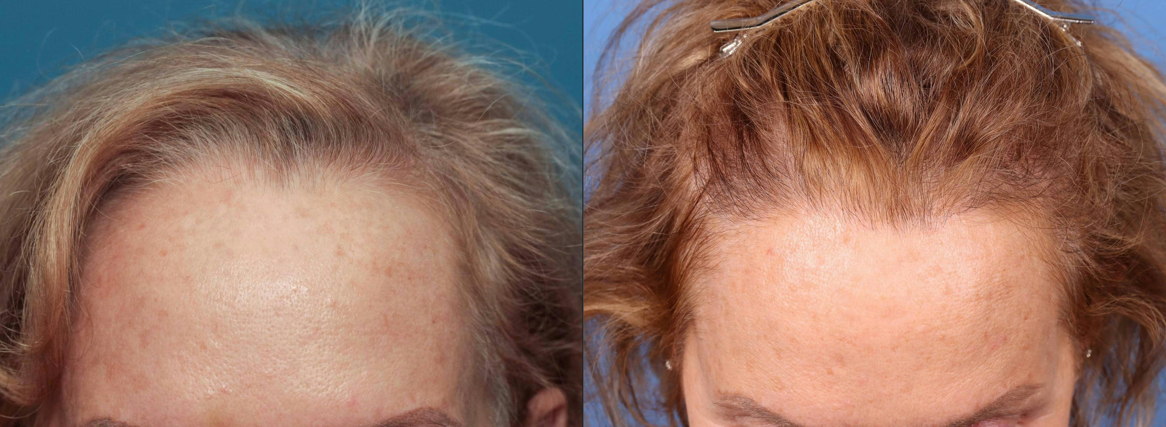 Female Hair Restoration Before & After Gallery - Patient 131385334 - Image 1