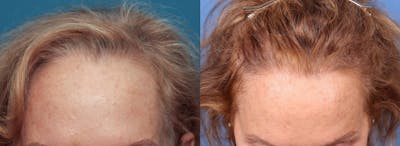 NeoGraft Hair Restoration Before & After Gallery - Patient 99346480 - Image 1