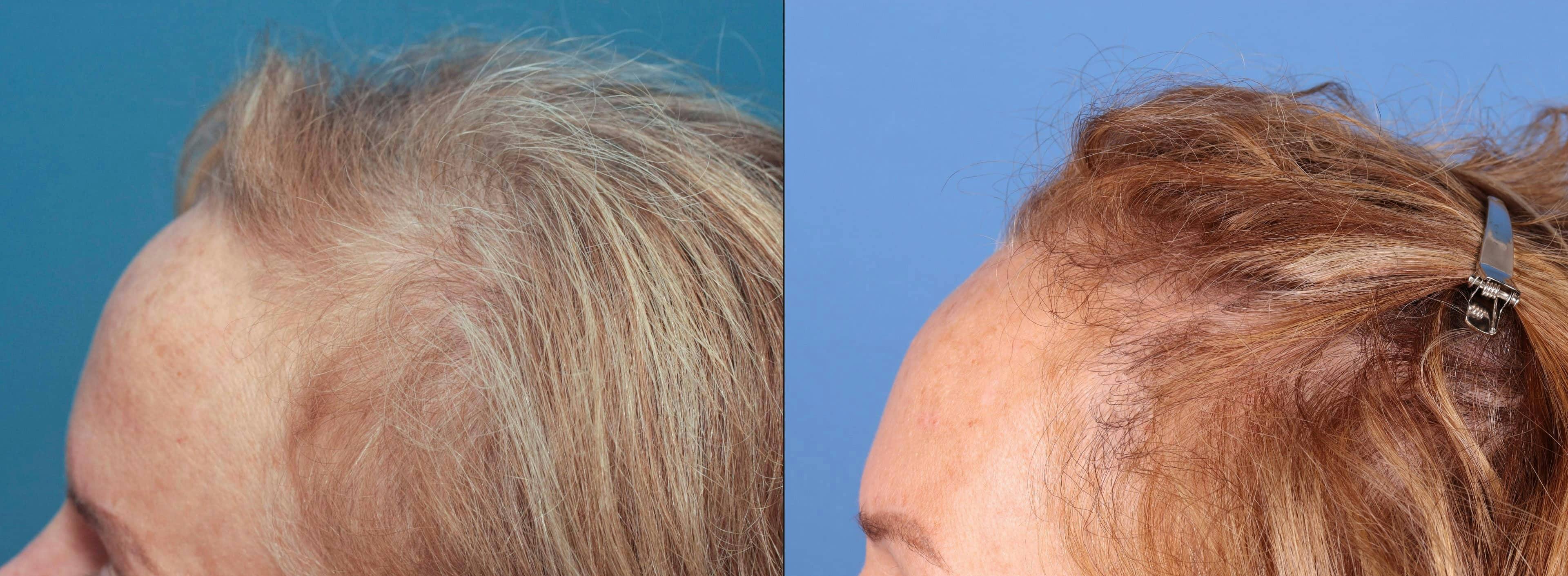 Female Hair Restoration Before & After Gallery - Patient 131385334 - Image 2