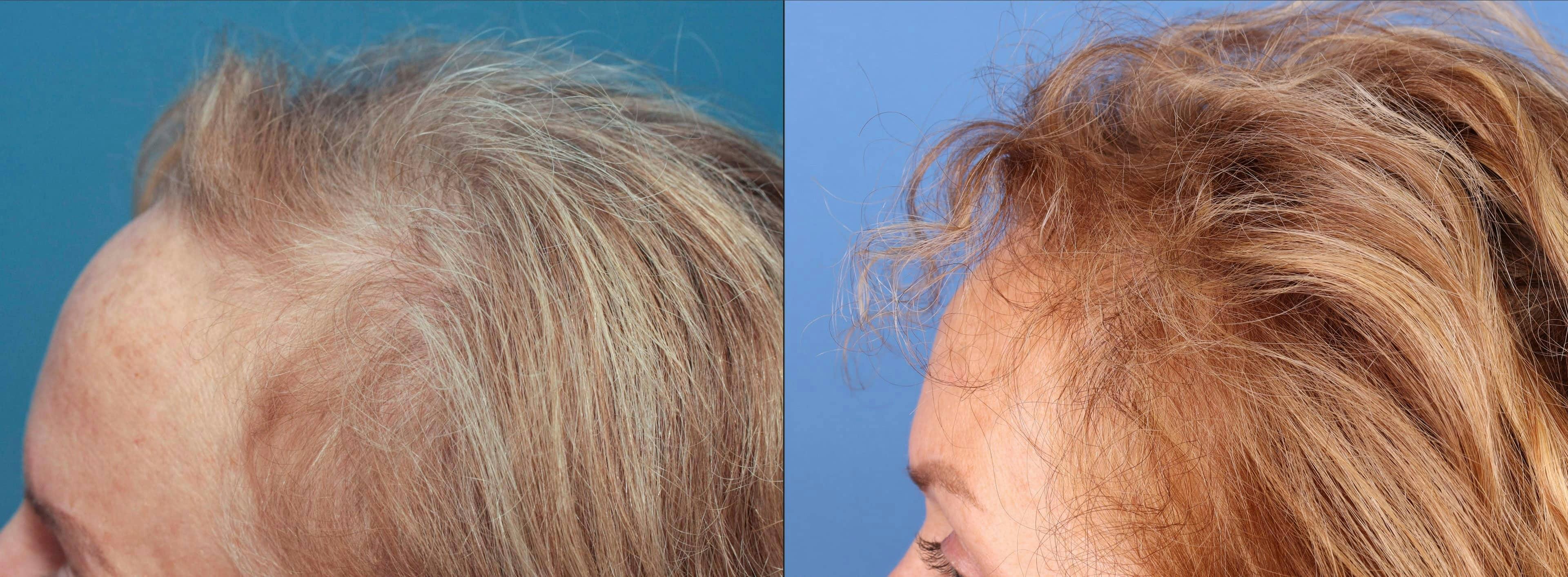 Female Hair Restoration Gallery - Patient 131385334 - Image 3