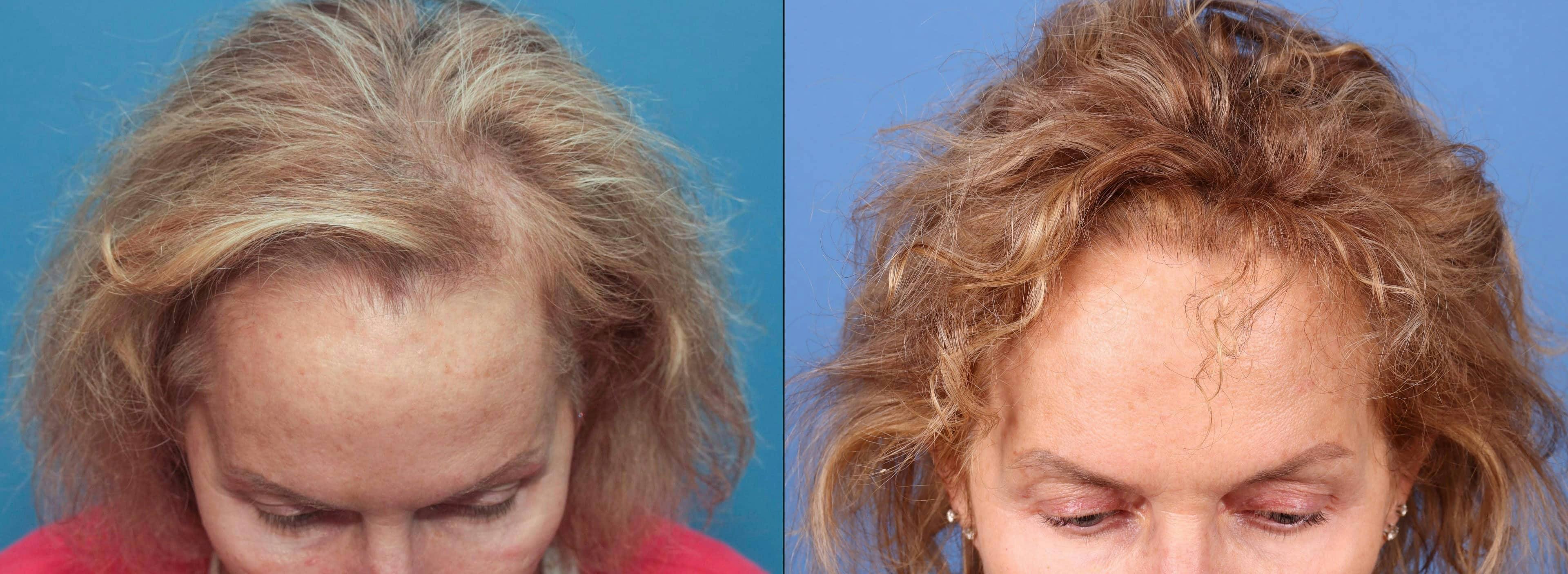 Female Hair Restoration Before & After Gallery - Patient 131385334 - Image 4