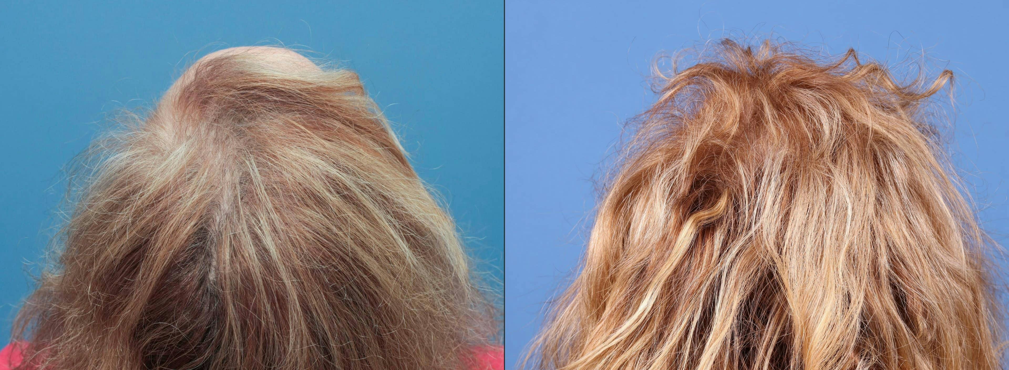 Female Hair Restoration Gallery - Patient 131385334 - Image 5