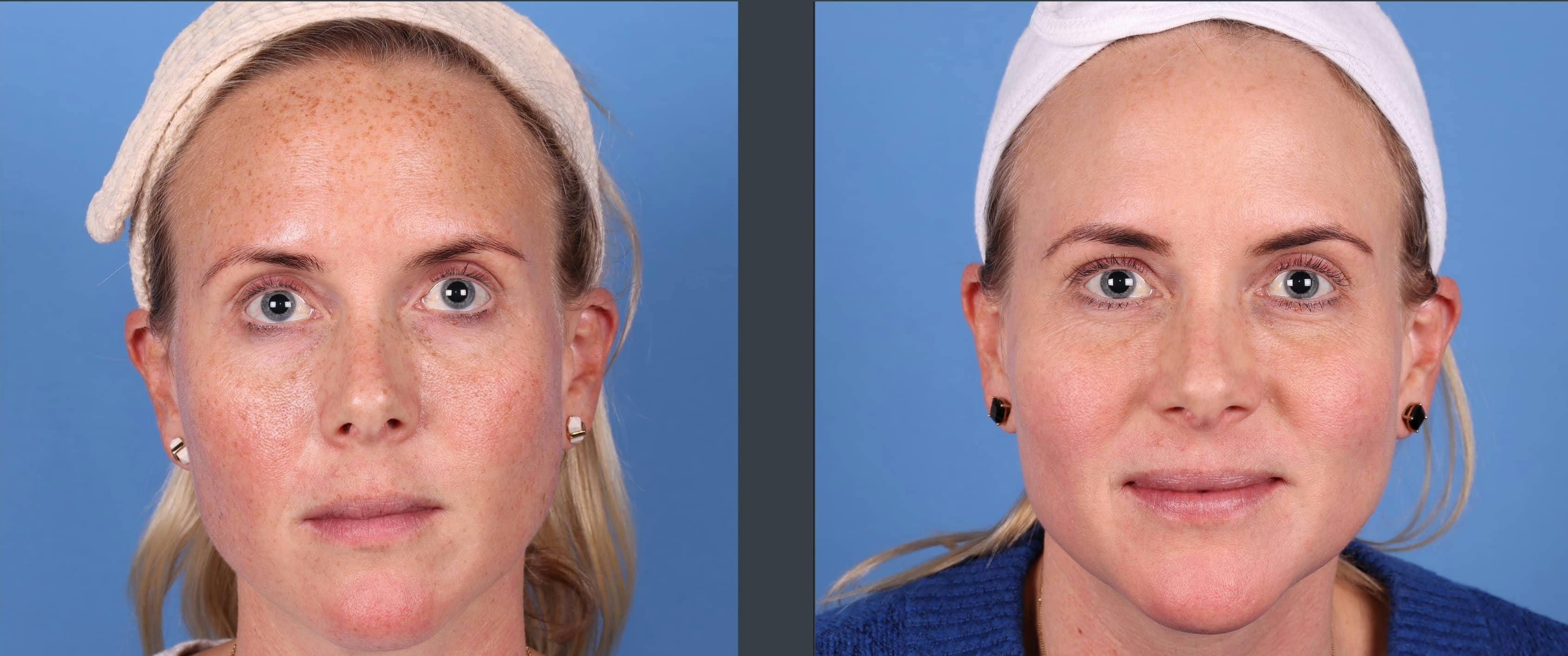 Laser Treatments Gallery - Patient 99346589 - Image 1