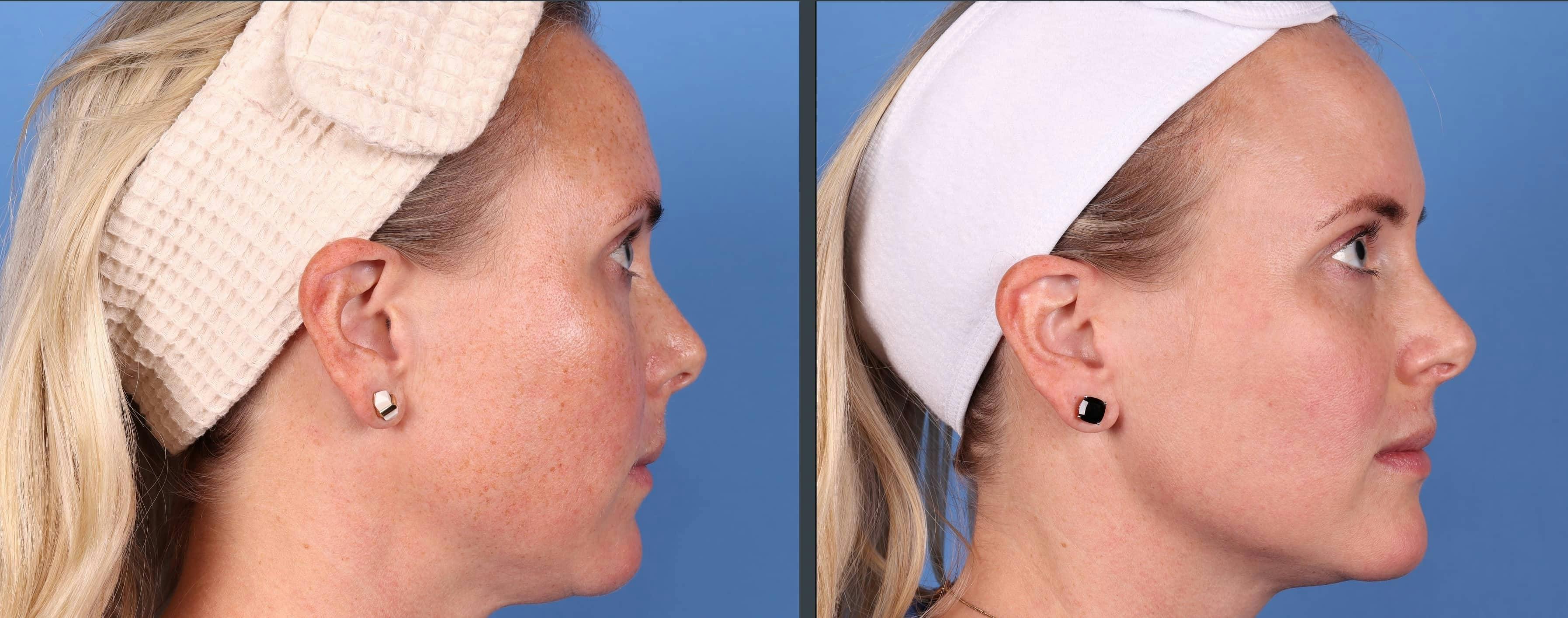 Laser Treatments Before & After Gallery - Patient 99346589 - Image 2