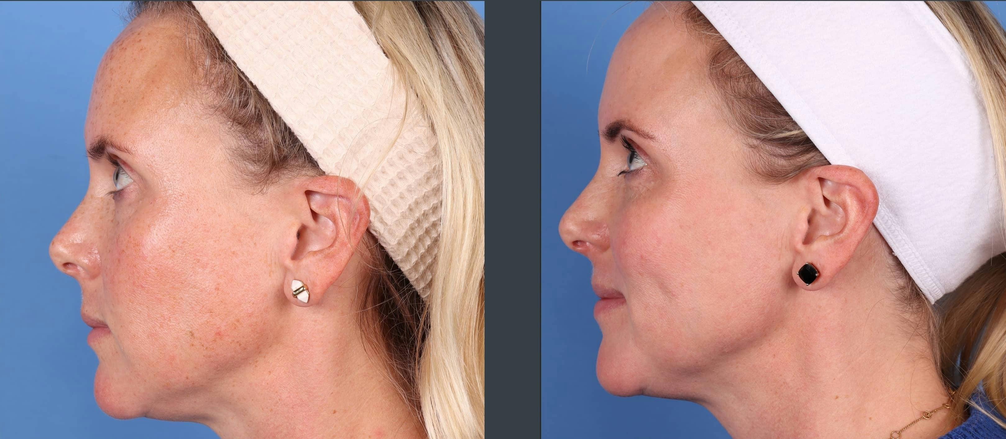 Laser Treatments Before & After Gallery - Patient 99346589 - Image 3