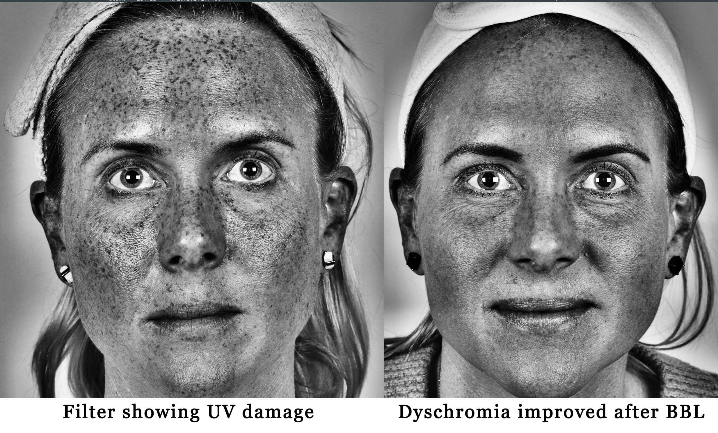 Laser Treatments Before & After Gallery - Patient 99346589 - Image 4
