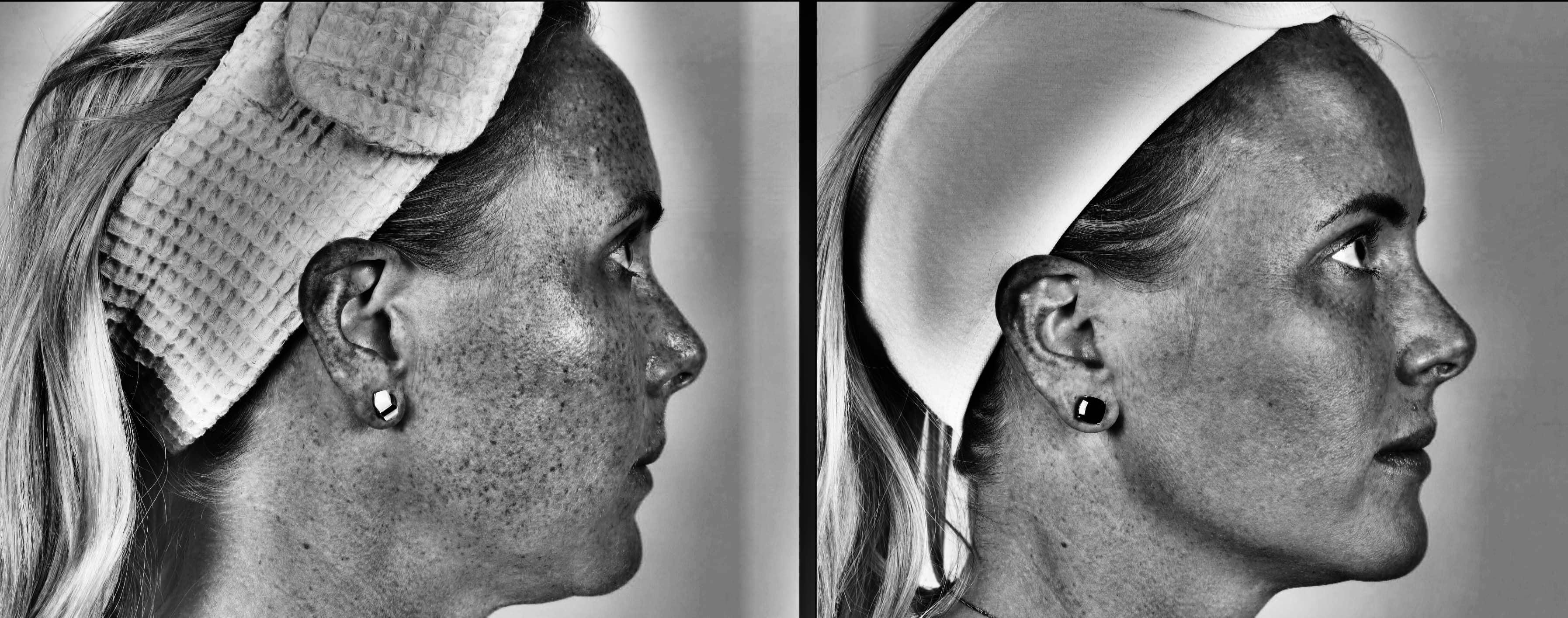 Laser Treatments Gallery - Patient 99346589 - Image 5