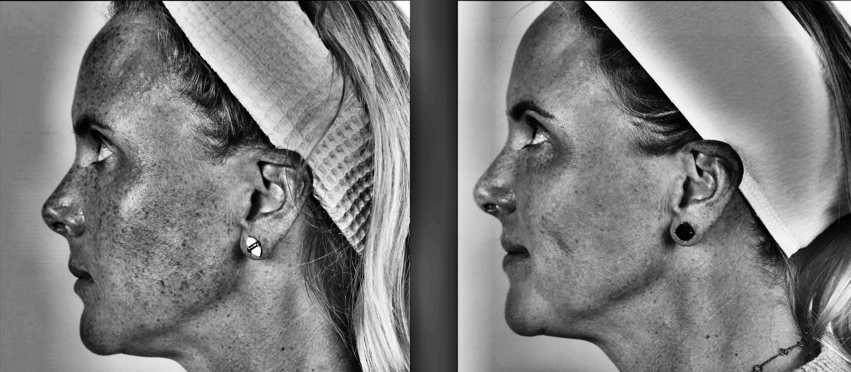 Laser Treatments Before & After Gallery - Patient 99346589 - Image 6