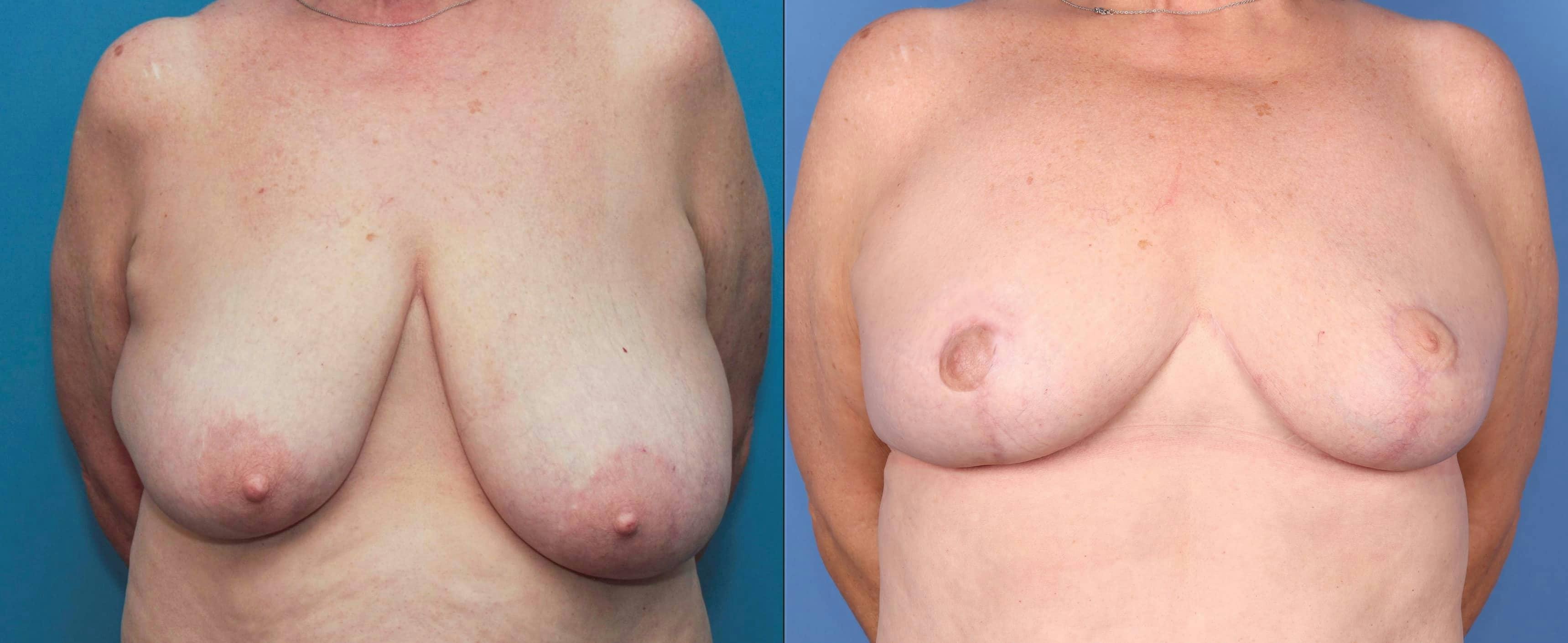 Breast Reduction Gallery - Patient 100695411 - Image 1