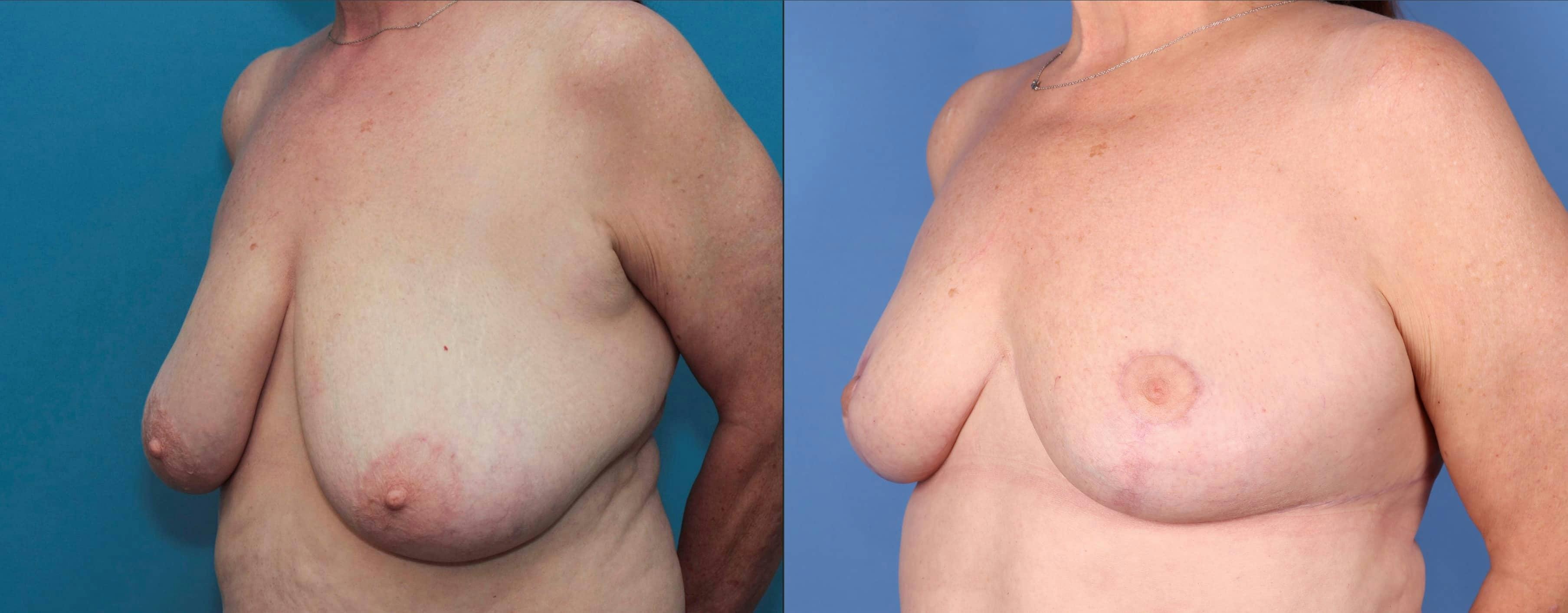 Breast Reduction Before & After Gallery - Patient 100695411 - Image 2