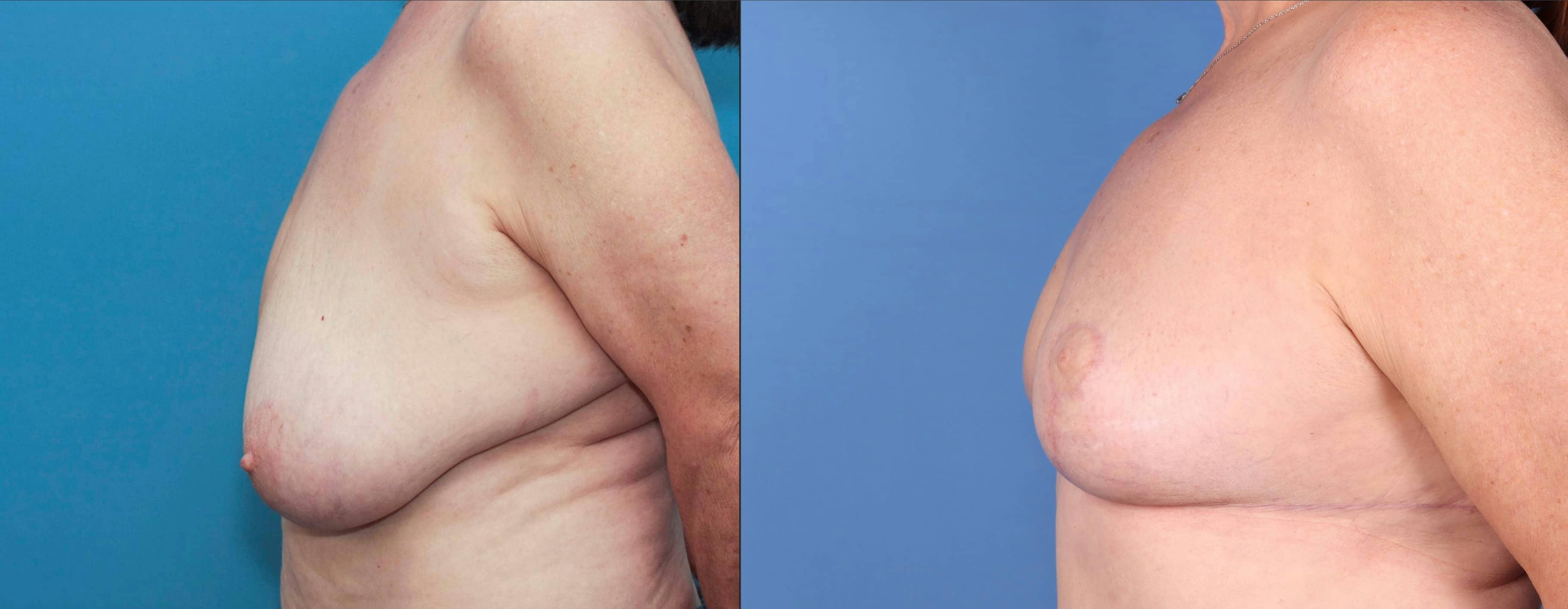 Breast Reduction Before & After Gallery - Patient 100695411 - Image 3