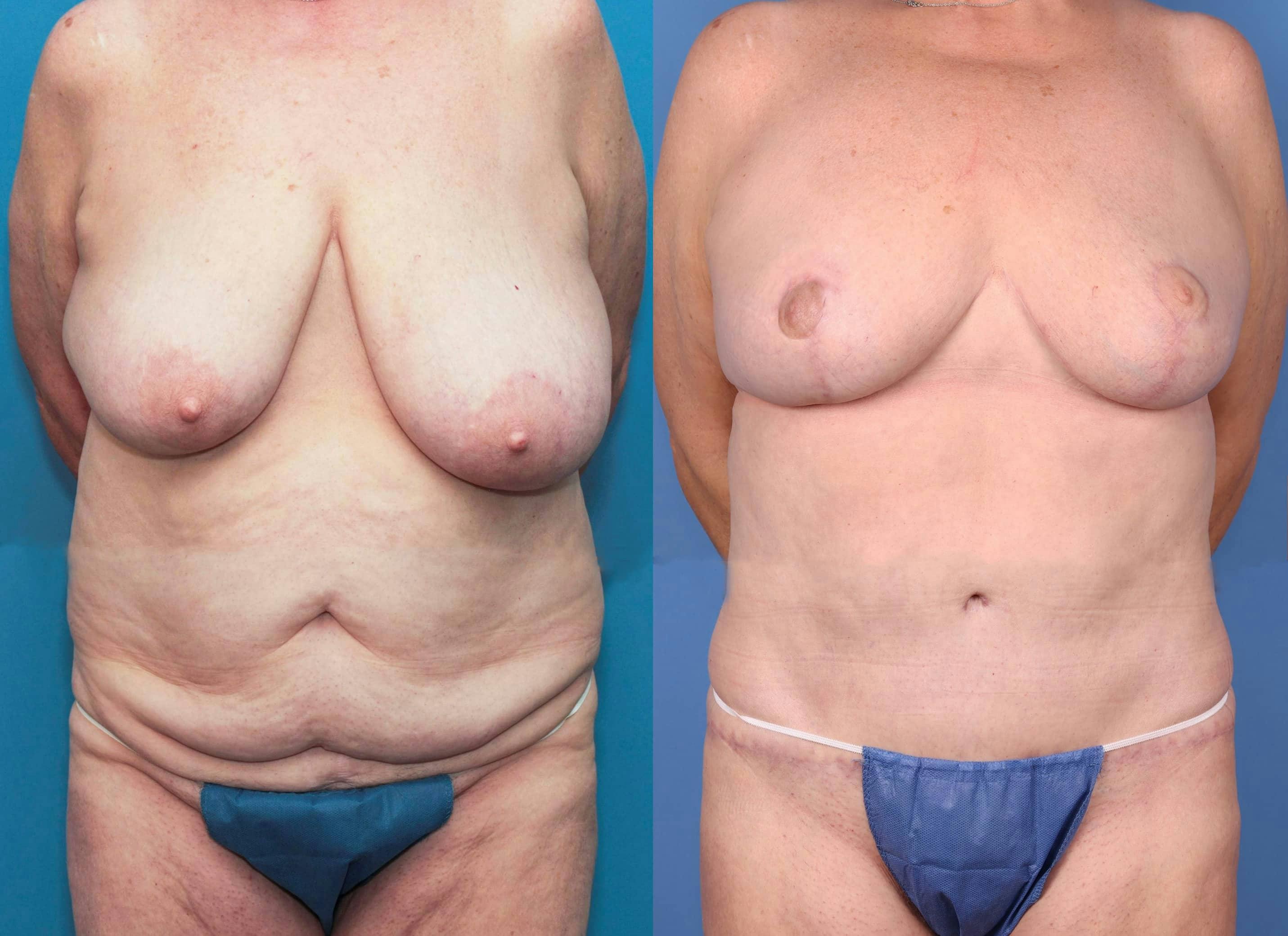 Tummy Tuck Before & After Gallery - Patient 100695860 - Image 1