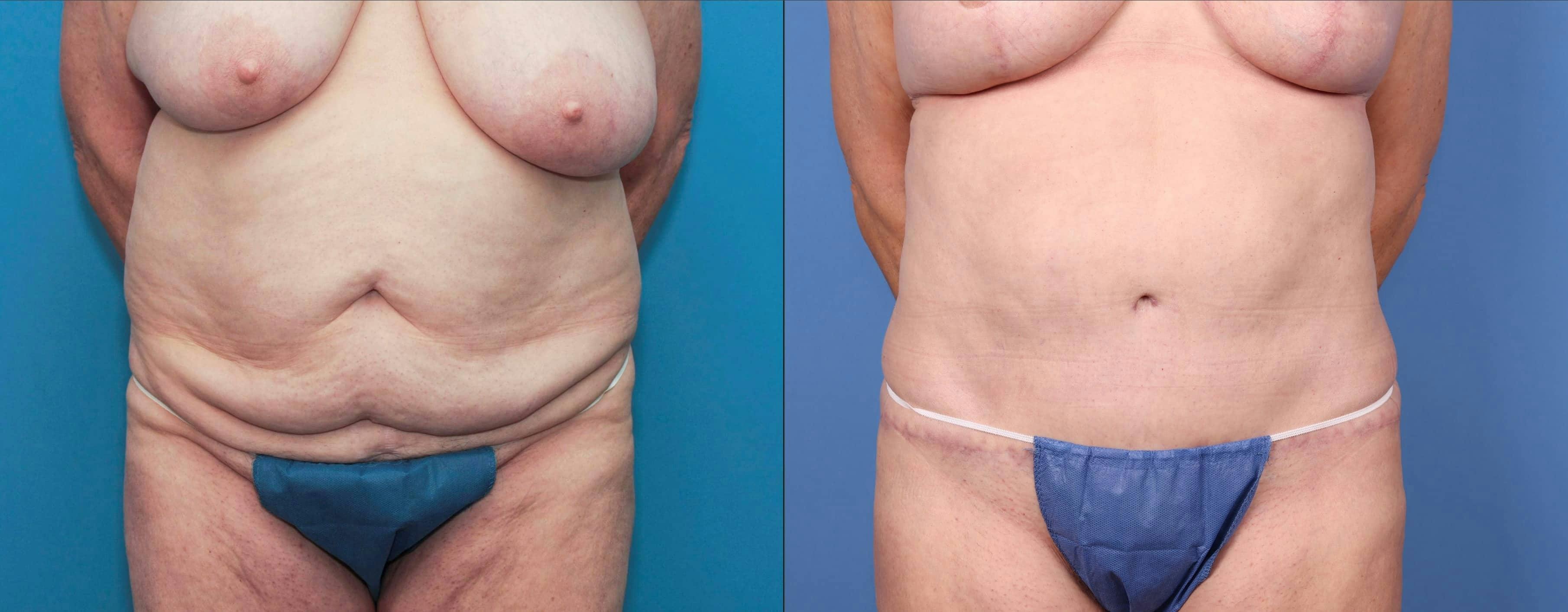 Tummy Tuck Before & After Gallery - Patient 100695860 - Image 2