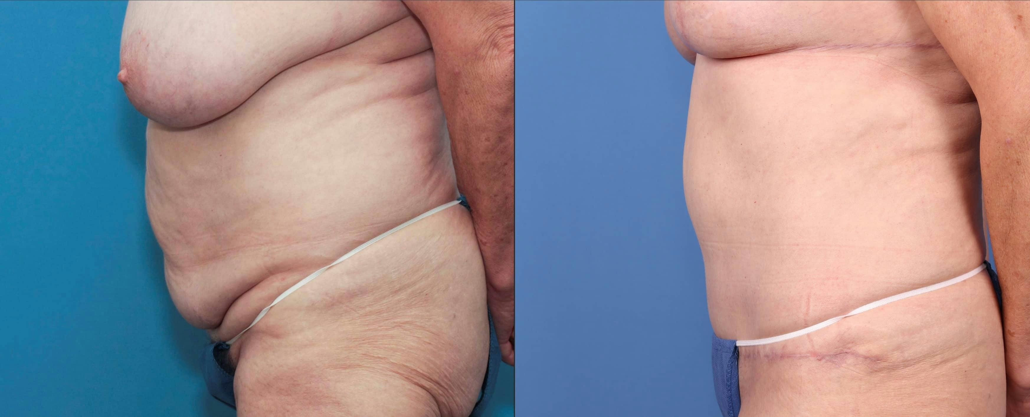 Tummy Tuck Before & After Gallery - Patient 100695860 - Image 3