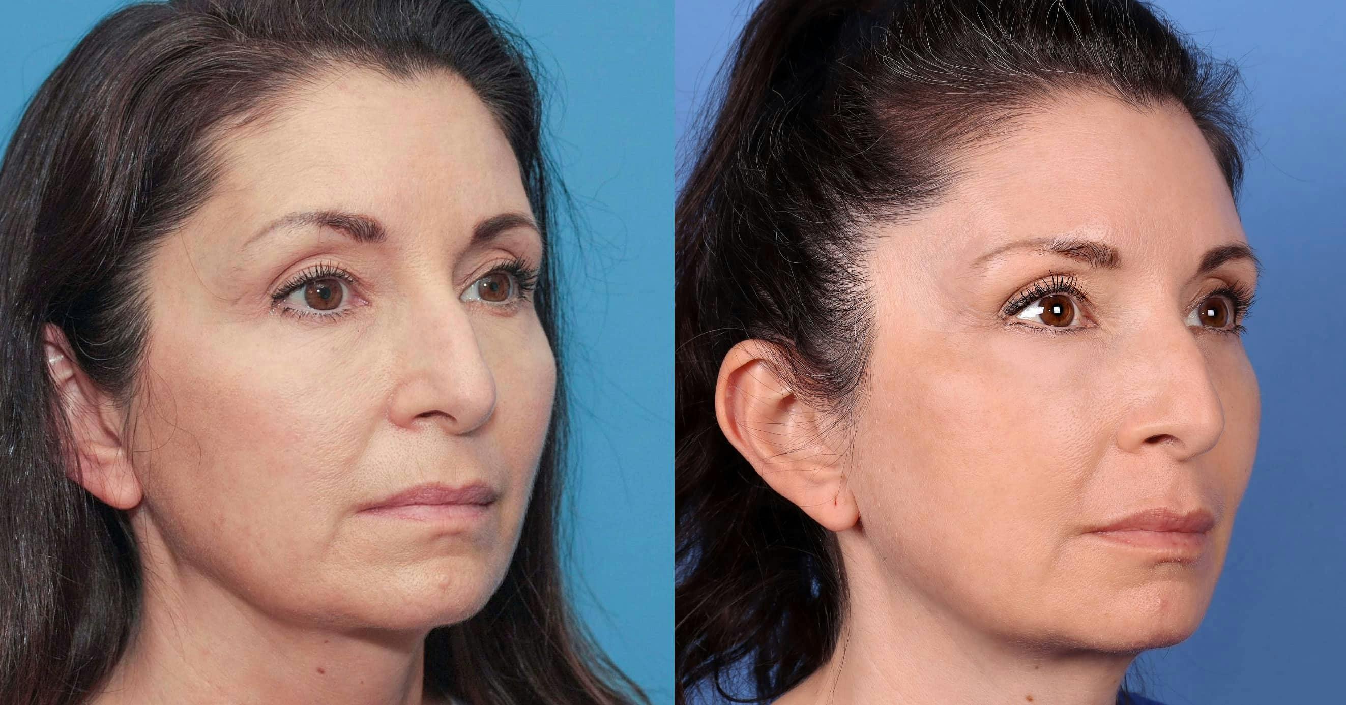 Contour TRL Laser Before & After Gallery - Patient 100695745 - Image 1
