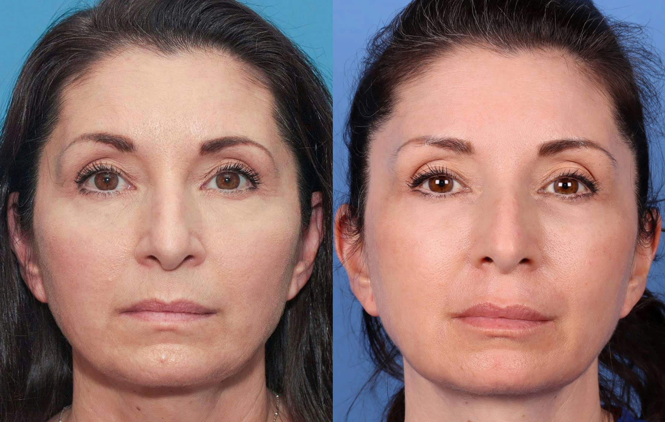 Contour TRL Laser Before & After Gallery - Patient 100695745 - Image 2