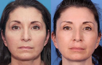 Contour TRL Laser Before & After Gallery - Patient 100695745 - Image 1
