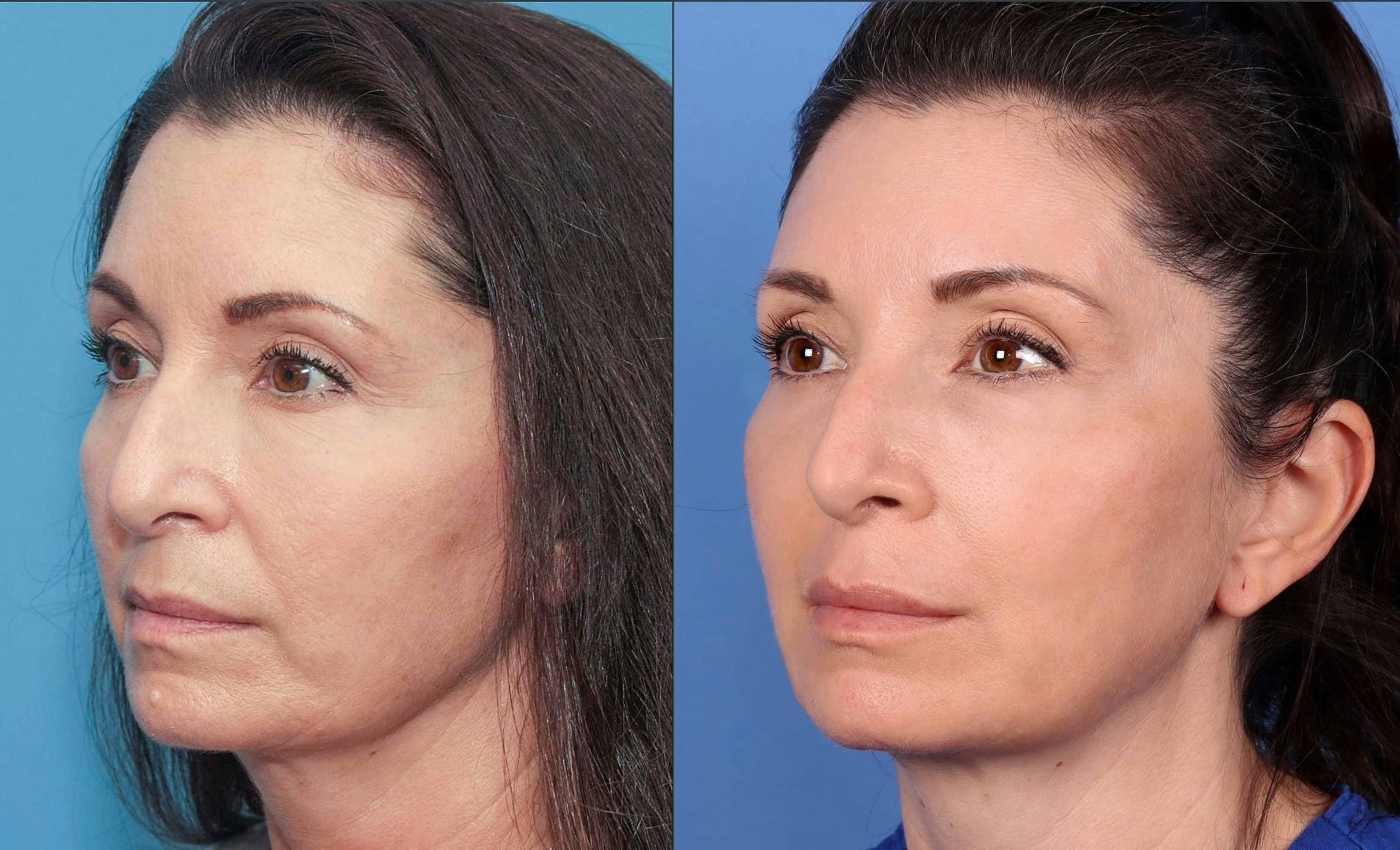 Contour TRL Laser Before & After Gallery - Patient 100695745 - Image 3