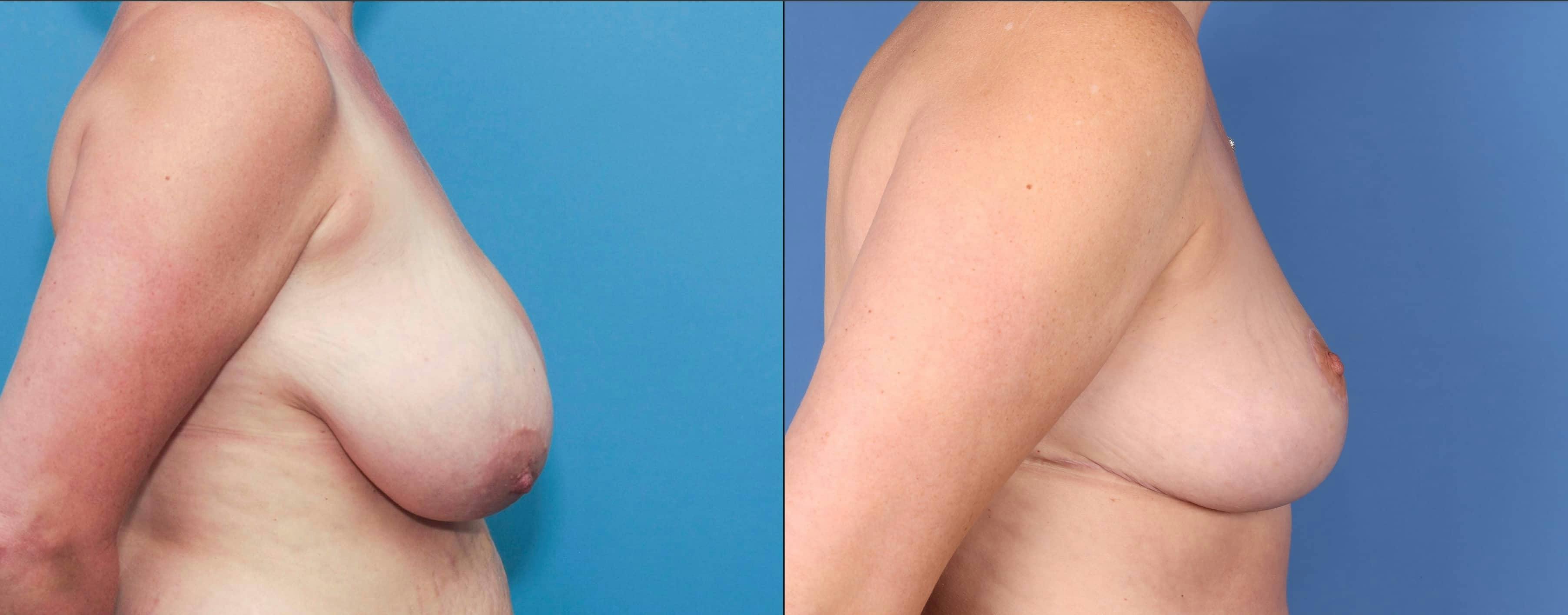 Breast Reduction Before & After Gallery - Patient 101097941 - Image 2