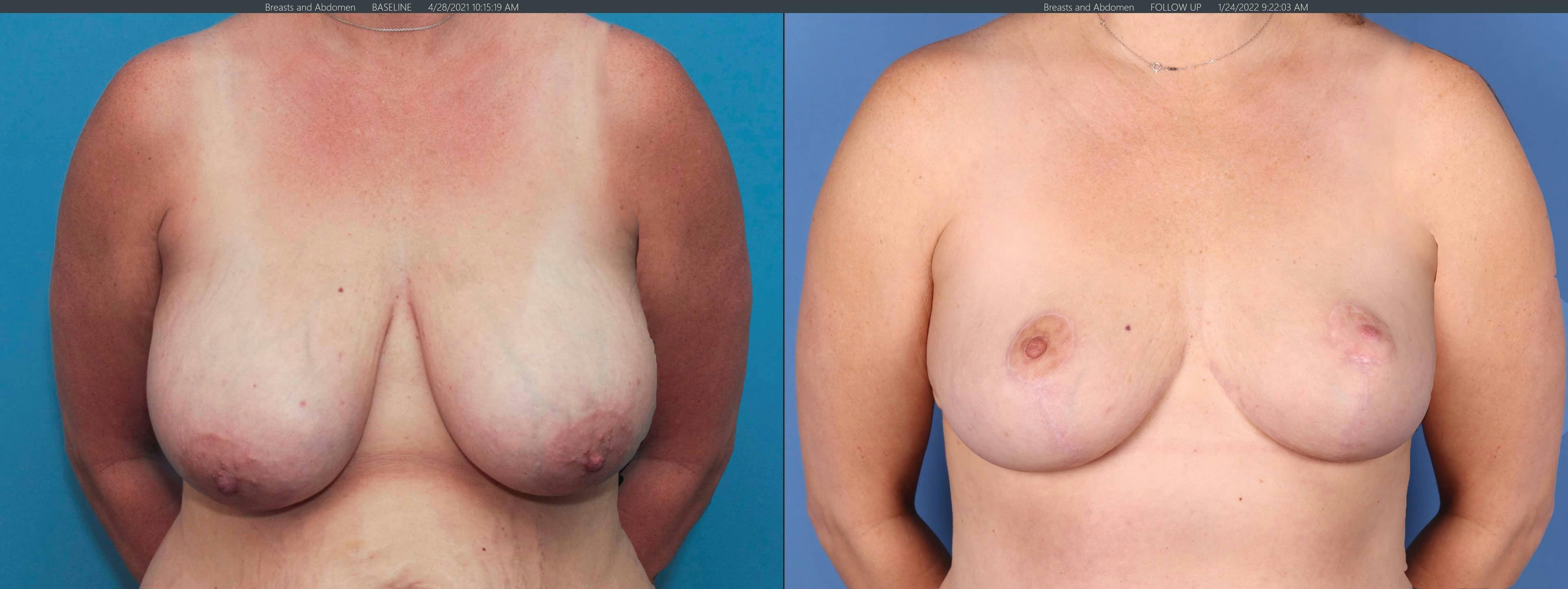 Breast Reduction Before & After Gallery - Patient 101097941 - Image 1