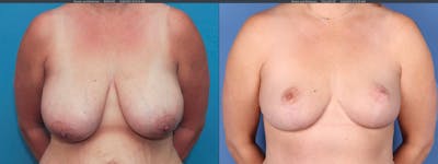 Breast Reduction Before & After Gallery - Patient 101097941 - Image 1
