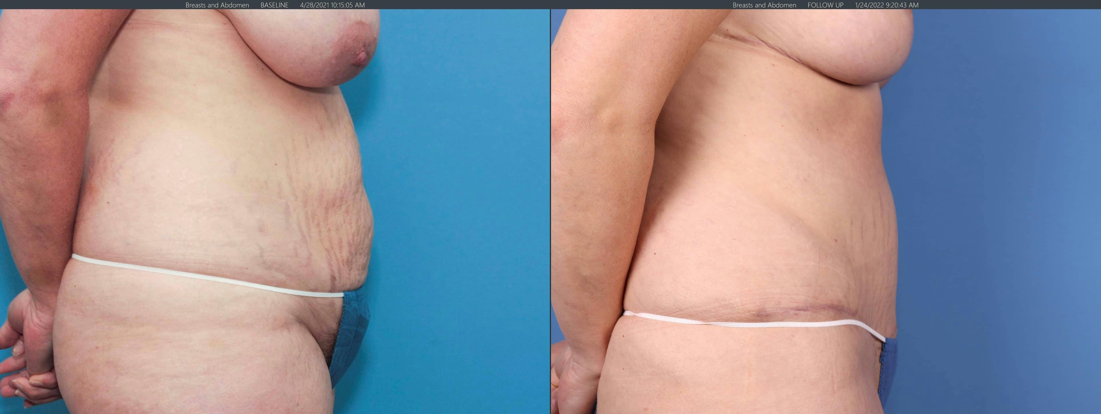 Tummy Tuck Before & After Gallery - Patient 101097955 - Image 2