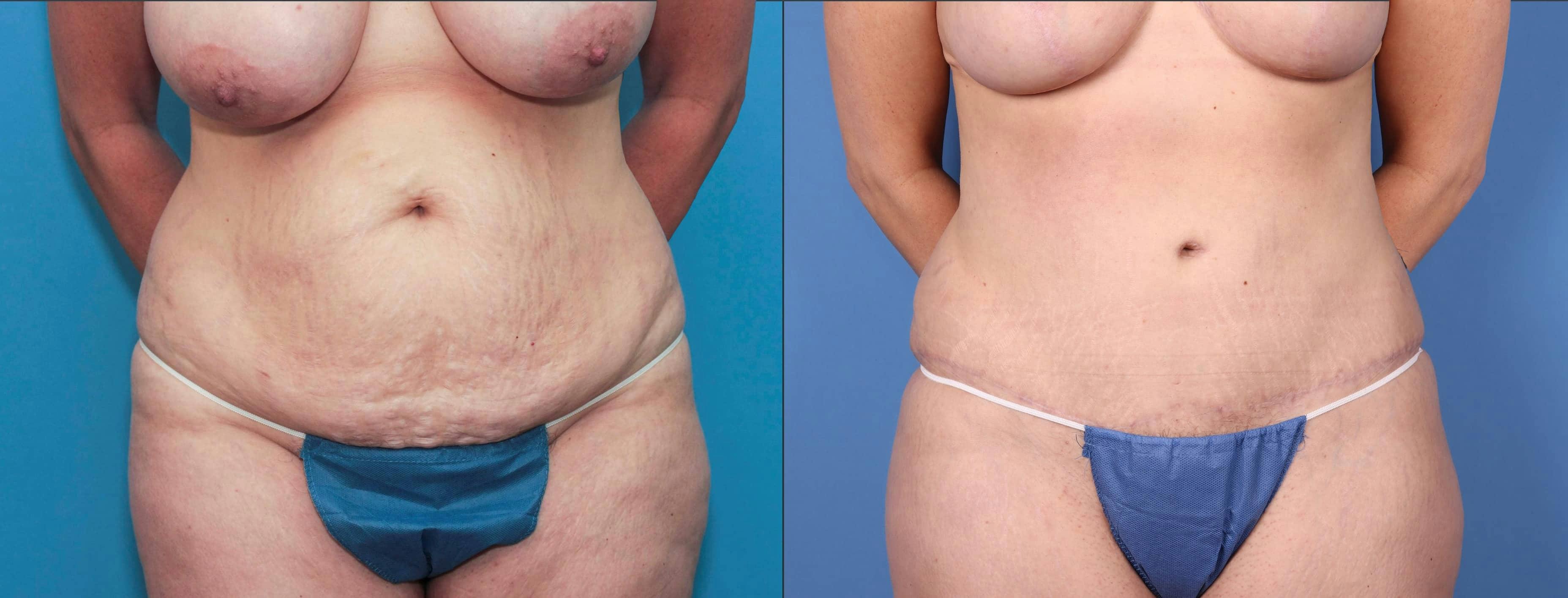Tummy Tuck Gallery - Patient 101097955 - Image 3
