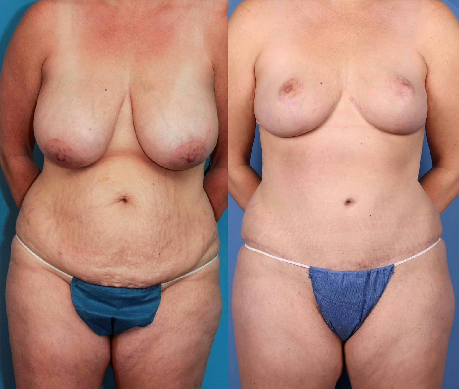 Tummy Tuck Before & After Gallery - Patient 101097955 - Image 1