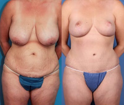 Tummy Tuck Before & After Gallery - Patient 101097955 - Image 1