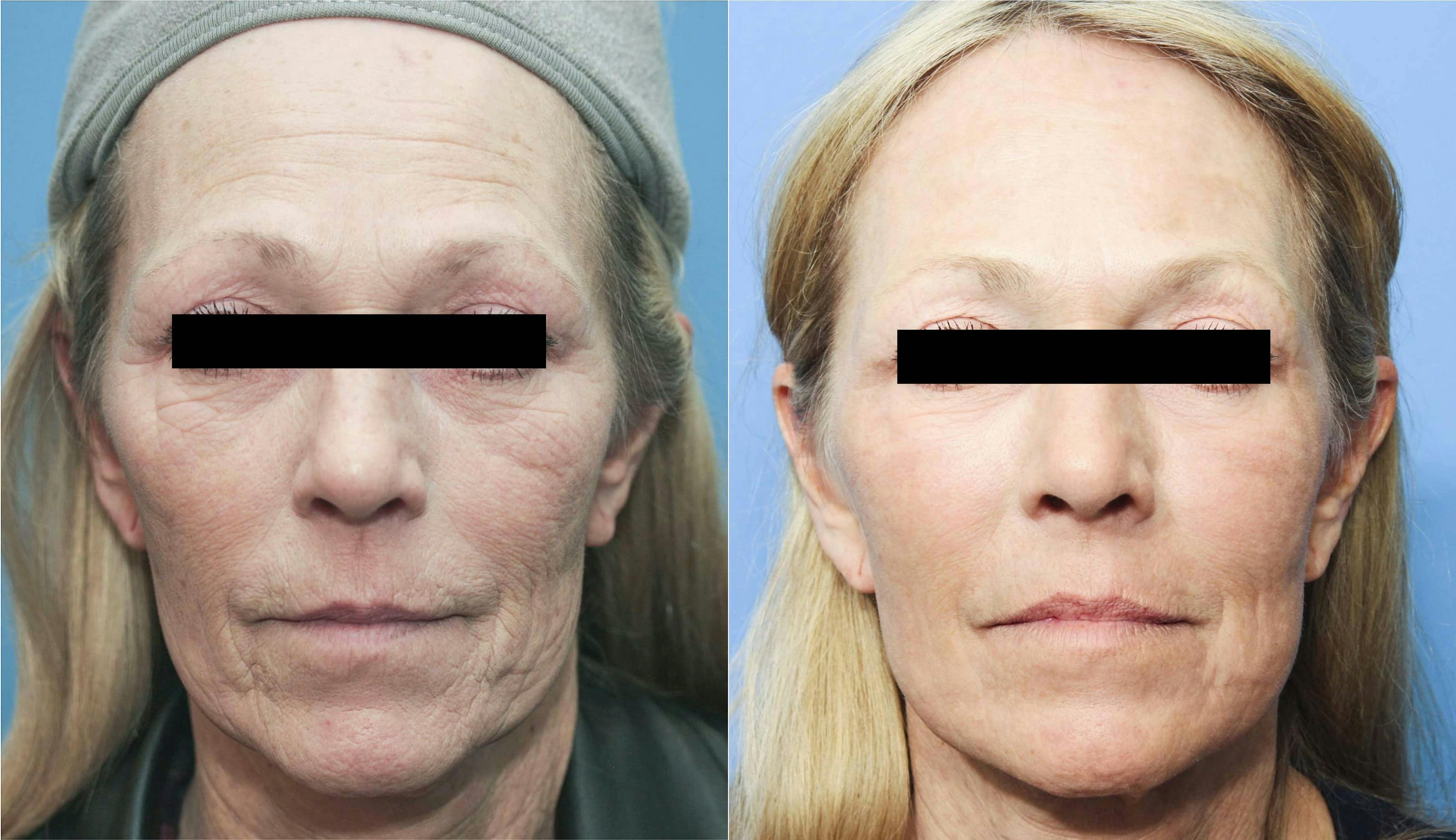 Contour TRL Laser Before & After Gallery - Patient 101098024 - Image 1