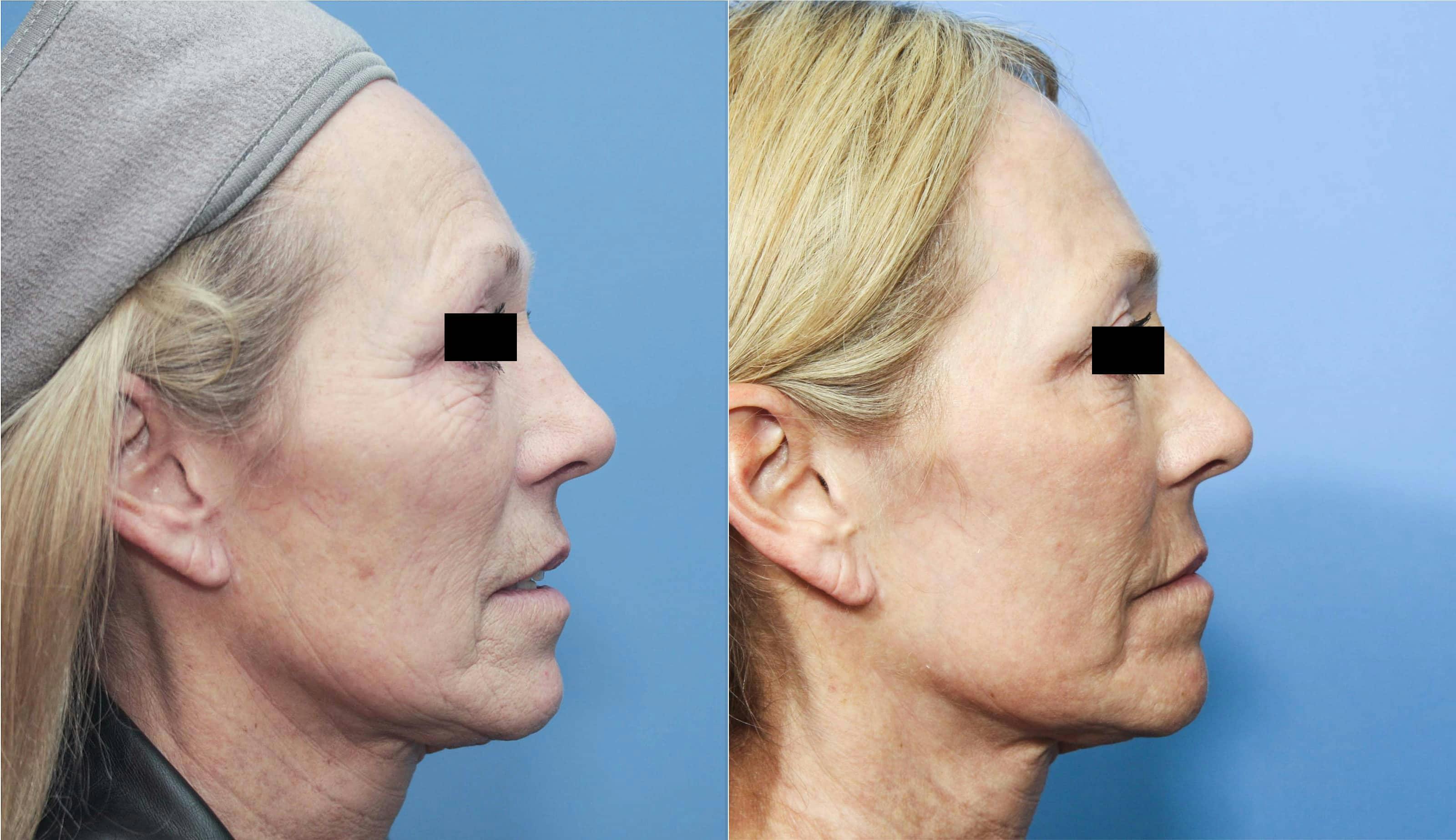 Contour TRL Laser Before & After Gallery - Patient 101098024 - Image 3