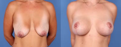 Breast Lift with Augmentation Before & After Gallery - Patient 101098122 - Image 1