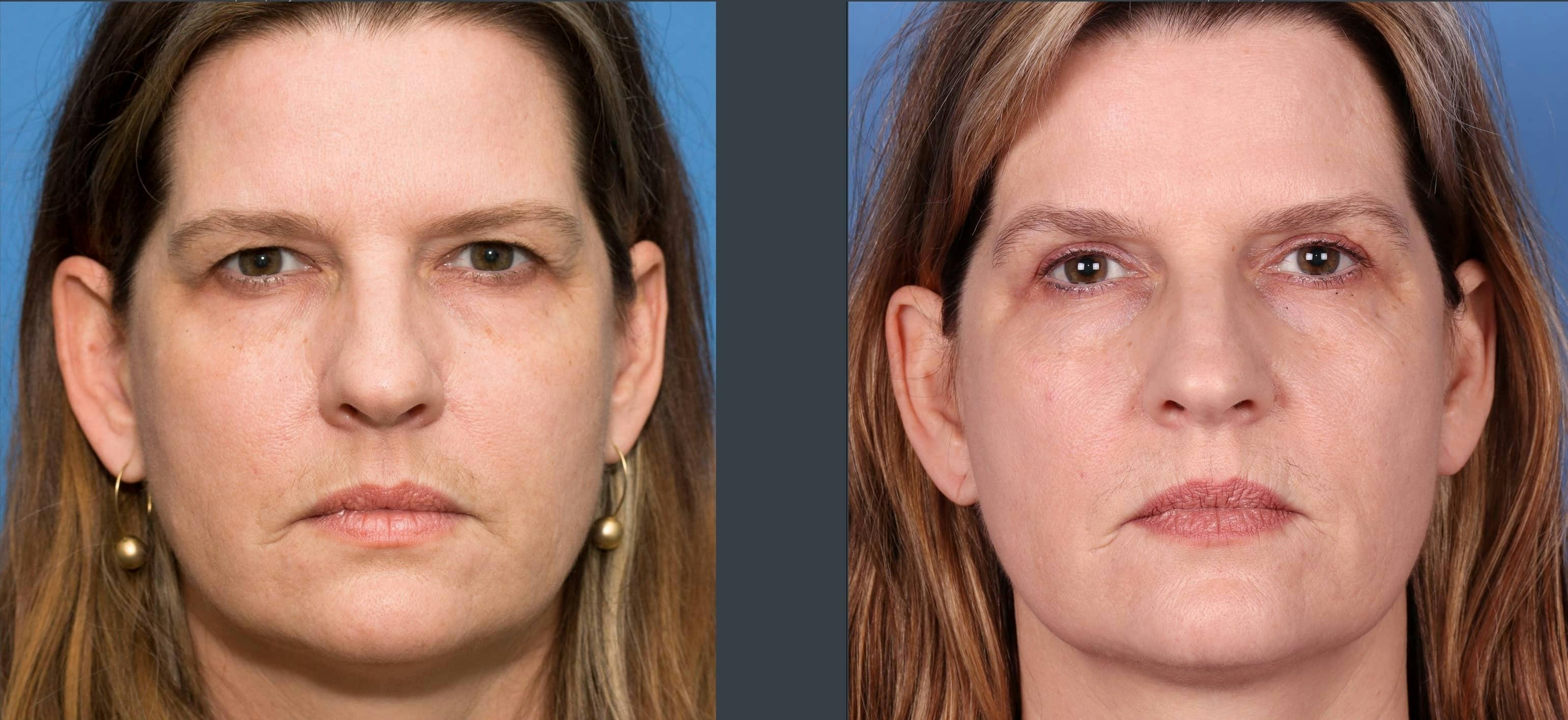 Eyelid Surgery (Blepharoplasty) Before & After Gallery - Patient 102566520 - Image 1
